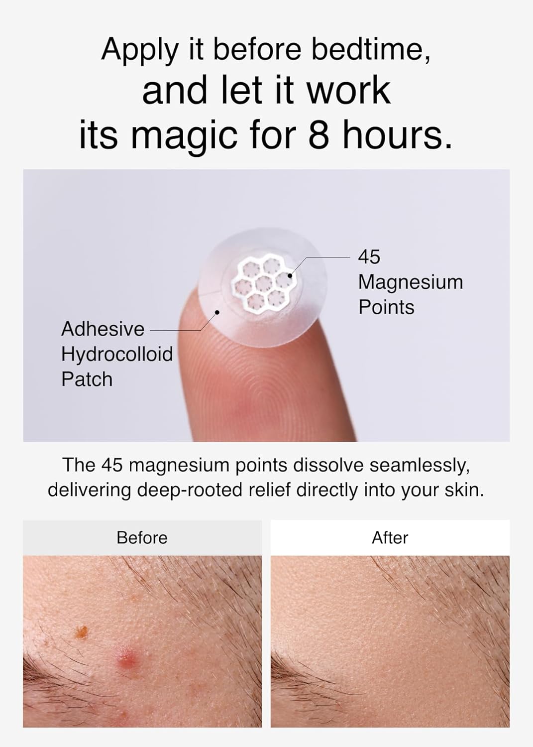 Thumbnail 4 de EasyDerm Quick Calming Magnesium Patches – Hydrocolloid Acne Spot Treatment