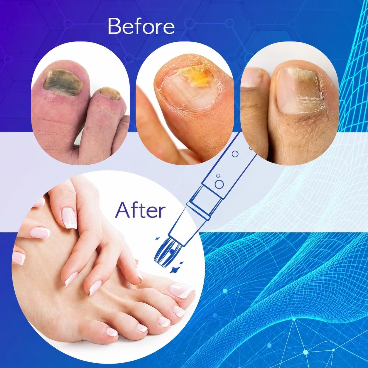 Thumbnail 4 de Fungal Nail Pen: 3-Piece Toenail Fungus Pen for Nail Repair and Discoloration