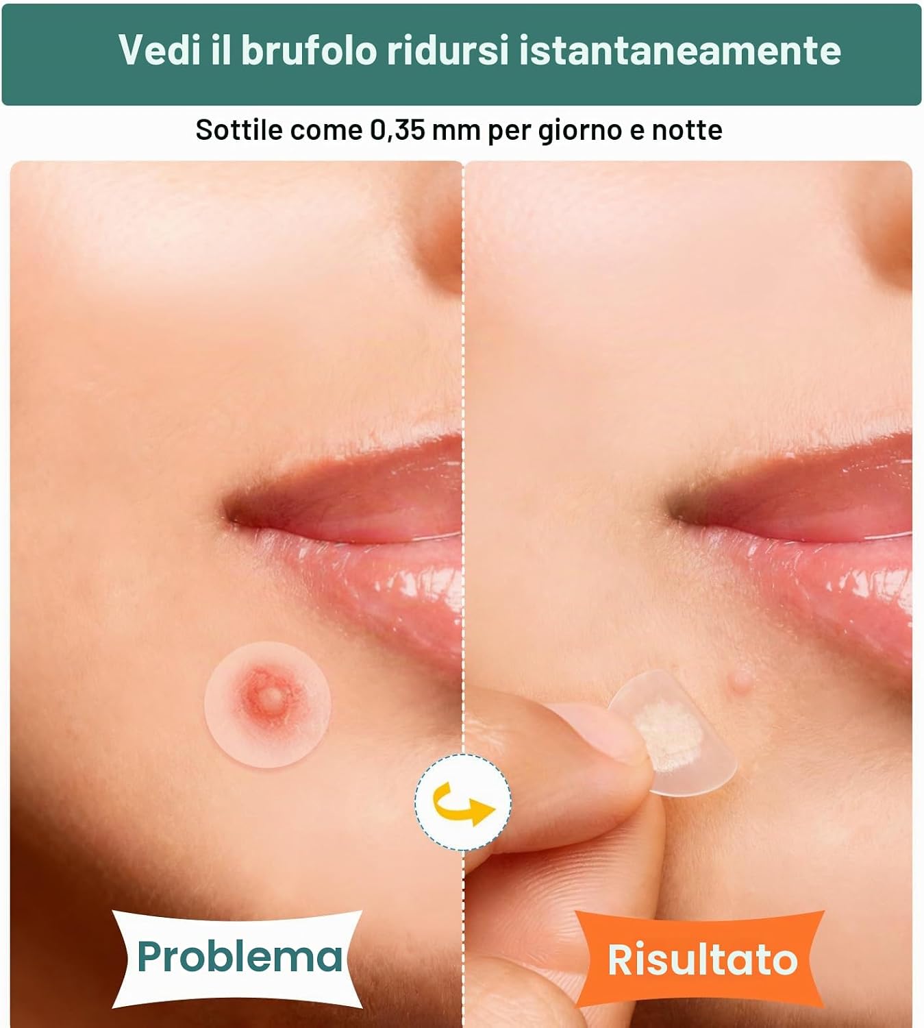 Thumbnail 3 de Patch Brufoli Pimple Patch XL for Face&Body: cerotti idrocolloidali per ampie zone (524) con tea tree