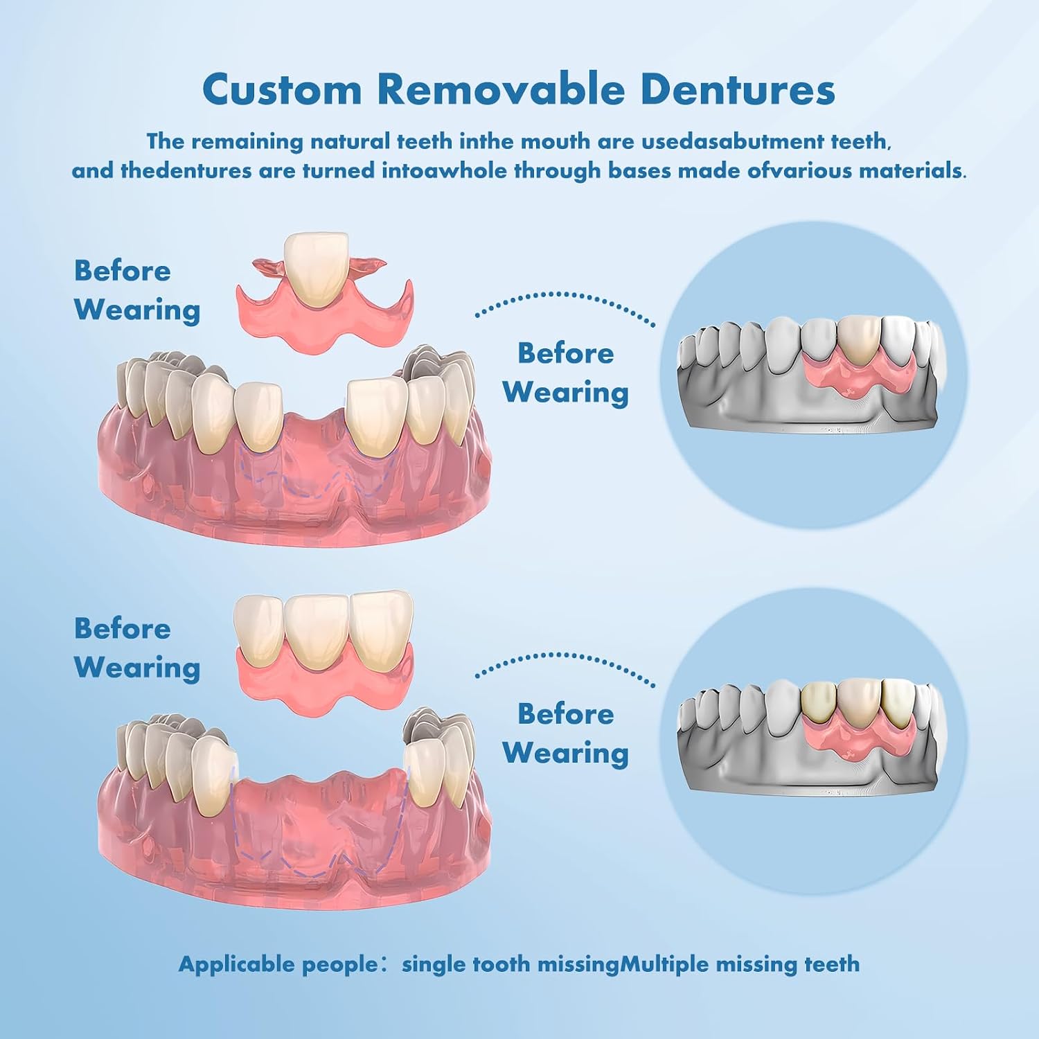 Detalle 2 de Custom Removable Dentures – Set for Tooth Replacement (1 Tooth) | Personalized Partial Denture with Storage Case