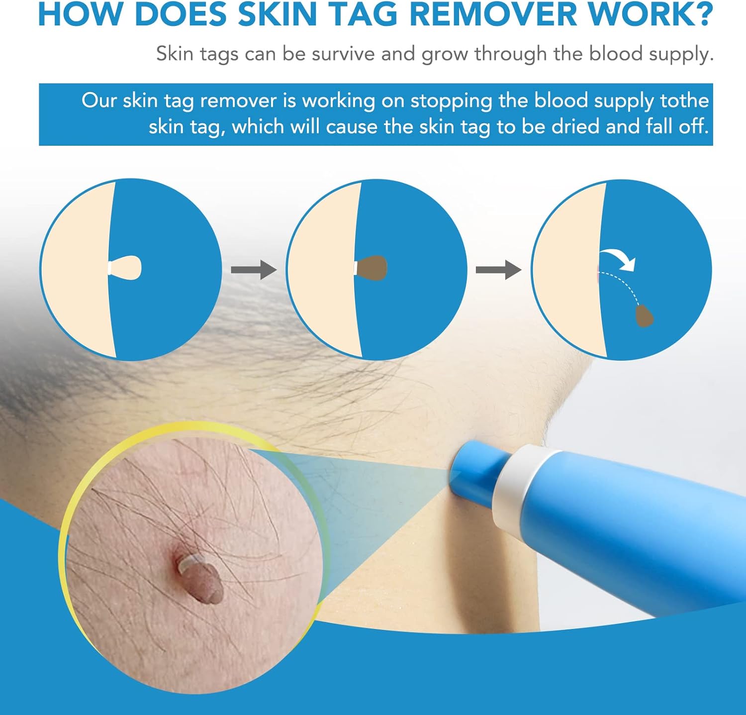 Detalle 2 de Skin Tag Removal Kit 40 bands 🩺