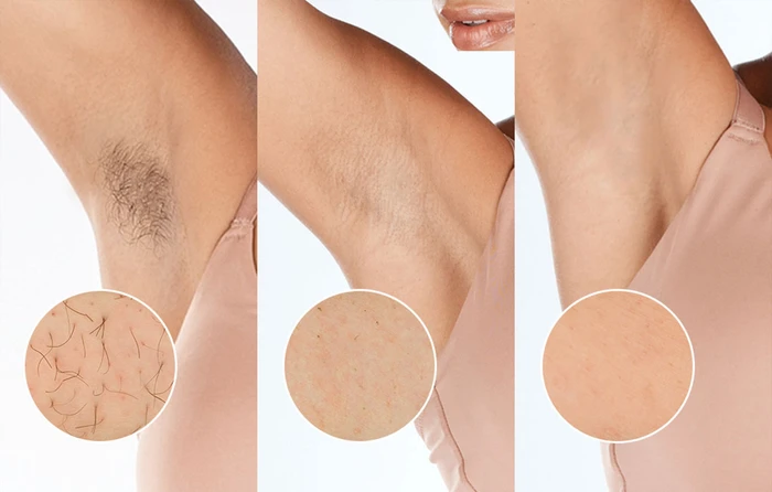 Detalle de Philips Lumea IPL 9900 Series BRI951/01 für präzises IPL