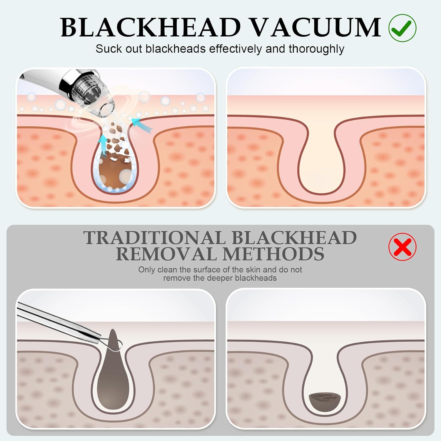 Thumbnail 4 de Blackhead Remover Pore Vacuum: 5 Probes, 3 Suction Levels, USB Rechargeable — White