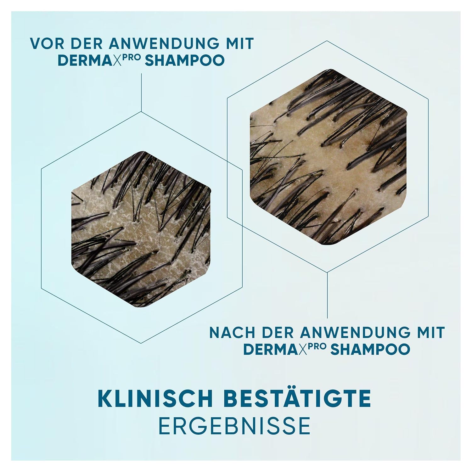 Detalle 2 de Head & Shoulders DermaXPro pflegendes Feuchtigkeits Anti-Schuppen-Shampoo mit Kokosöl und Ceramide-Komplex (500 ml)