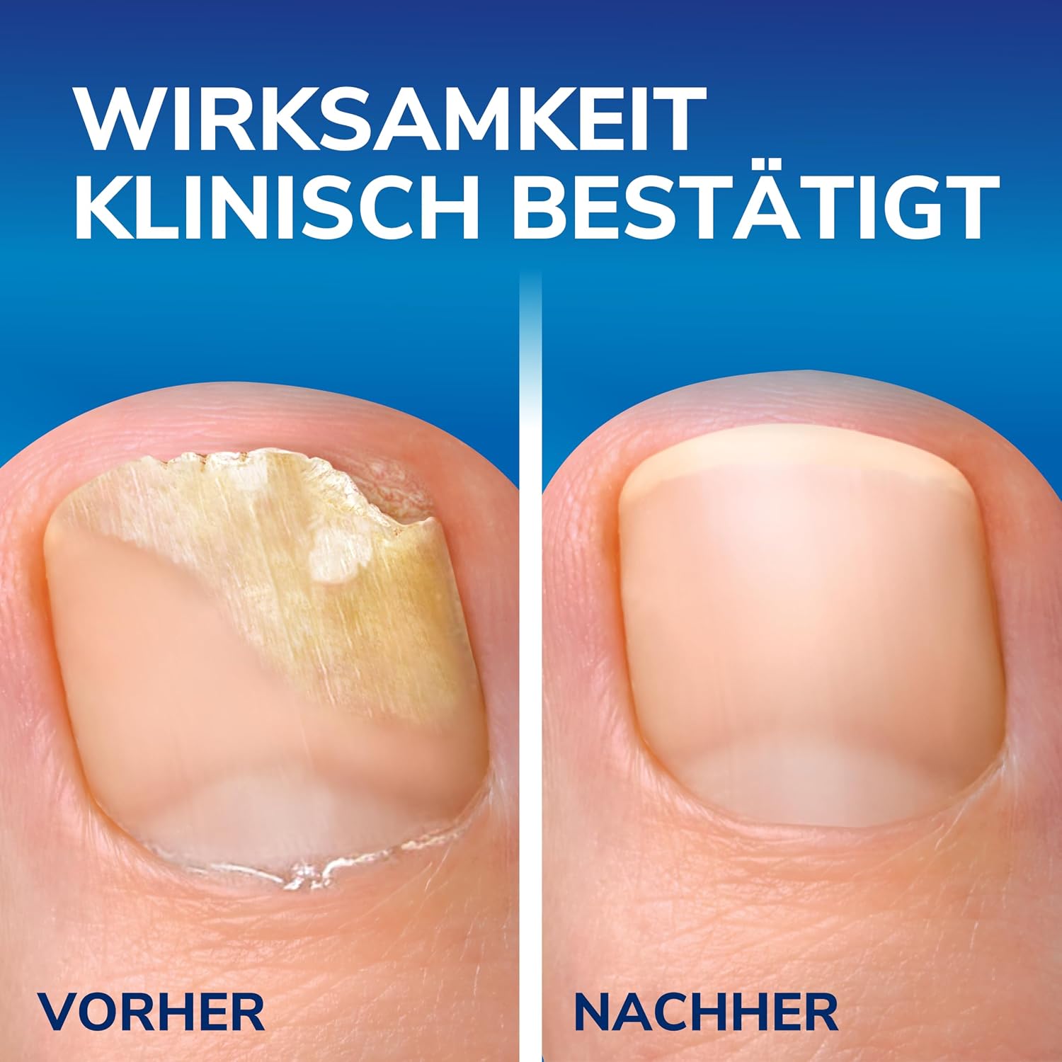 Detalle 2 de Scholl 2-in-1 Stift bei Nagelpilz – Wirksam gegen Nagelinfektionen am Ursprung