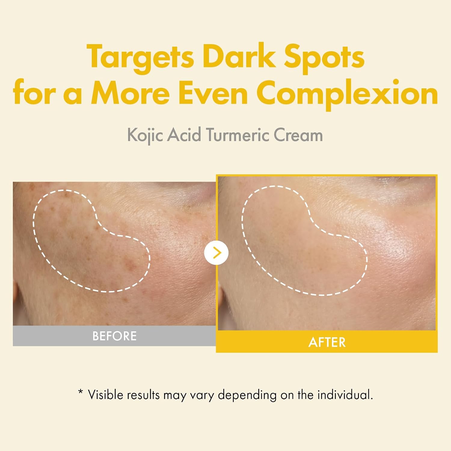 Thumbnail 1 de TOSOWOONG Kojic Acid Turmeric Cream (99% Kojic Acid), 50ml dark spot and uneven tone corrector