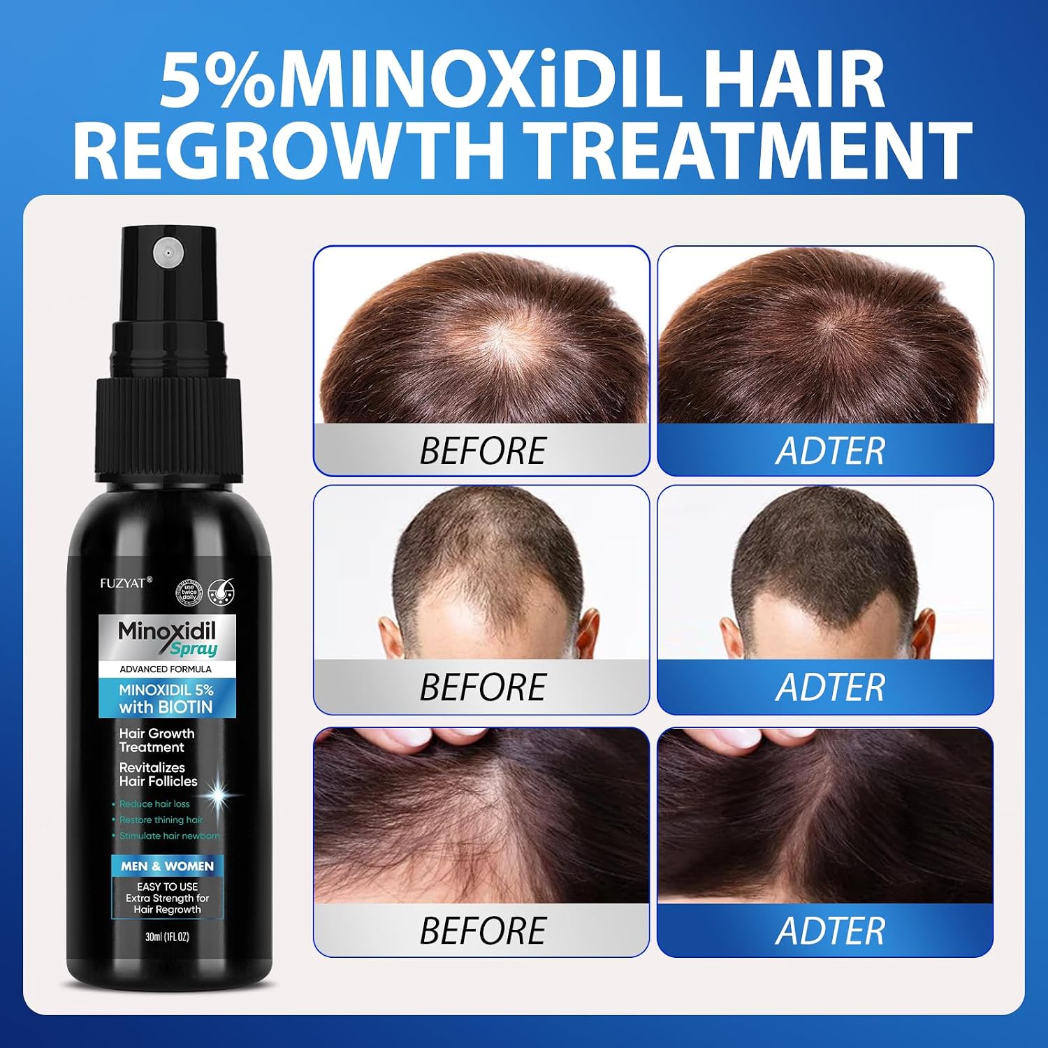 Thumbnail 2 de 5% Minoxidil Hair Growth Spray (Men & Women) with Biotin, 60ml