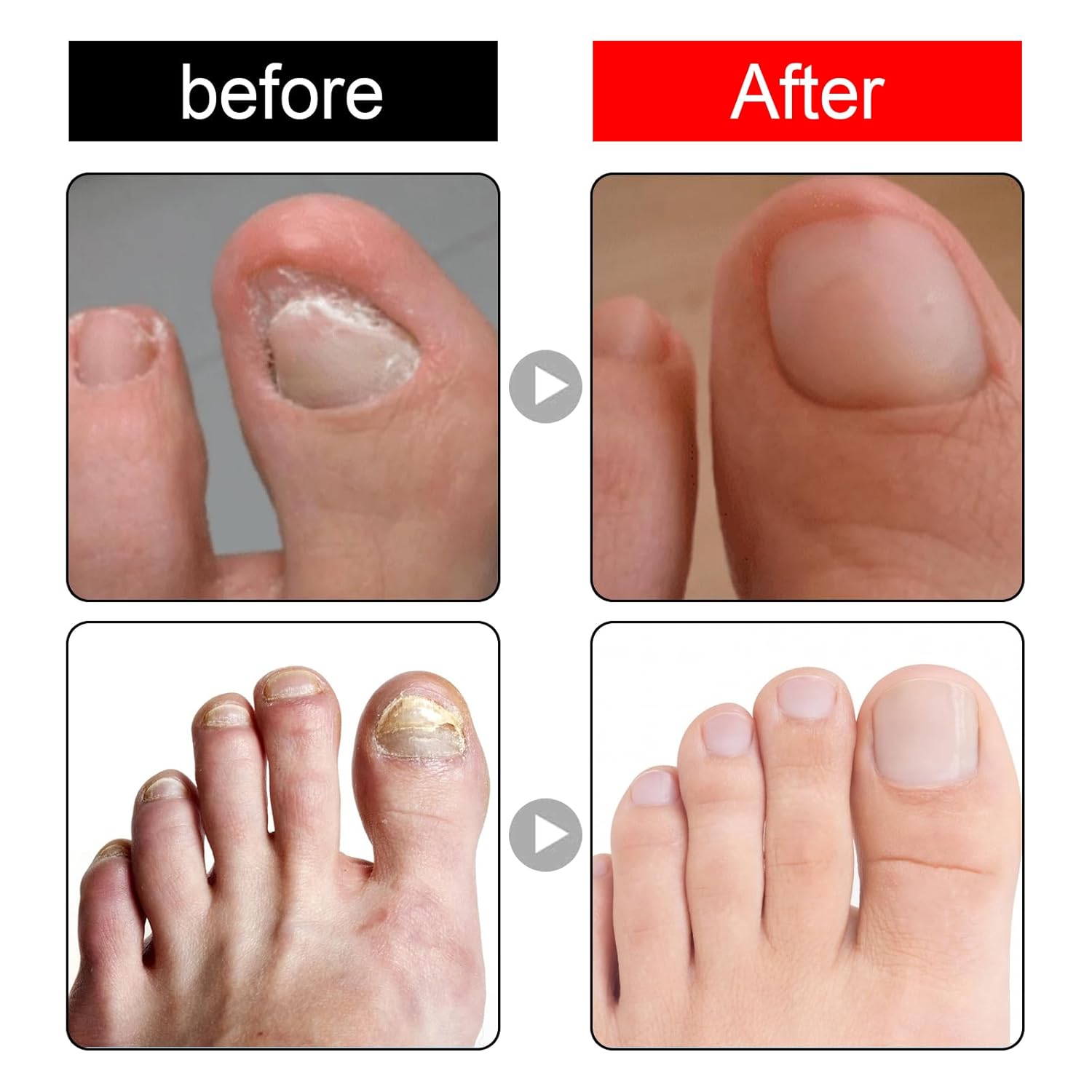 Thumbnail 5 de Eingewachsene Zehennägel Behandlung – 30 ml Nagelhautpflege-Öle zur Nagelpflege