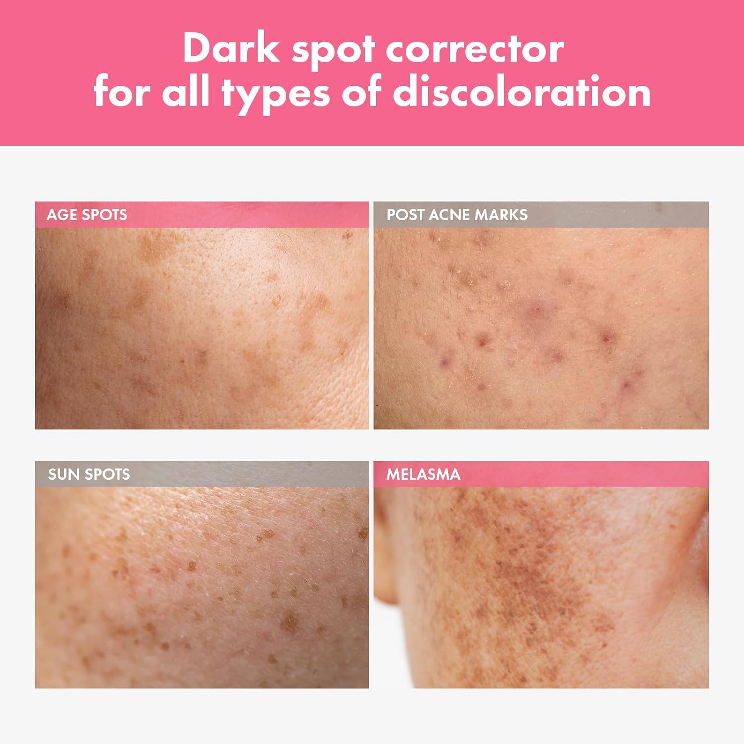 Thumbnail 1 de TOSOWOONG Arbutin 7% Intensive Spot Cream (70,000ppm), 20ml for Dark Spots & Freckles