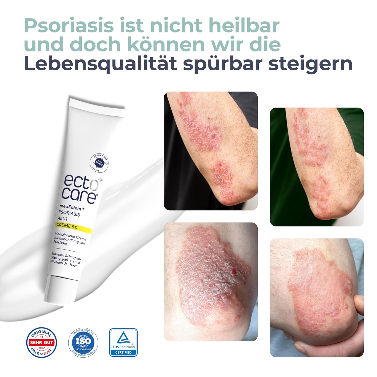Thumbnail 4 de ectocare® Psoriasis Creme Akut mit 5% Ectoin 30ml – kortisonfrei, dermatologisch geprüft