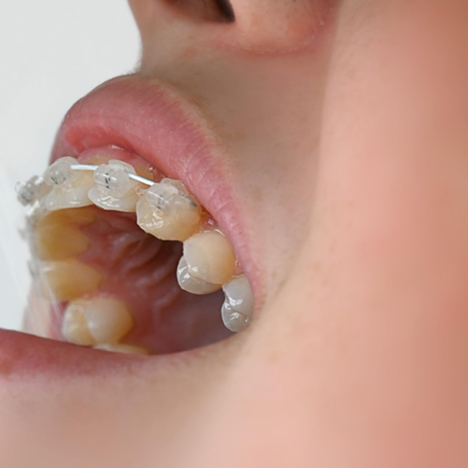 Detalle de Apa Care rimineralizzazione e MIH: set per denti calcarei, rimineralizzazione e protezione