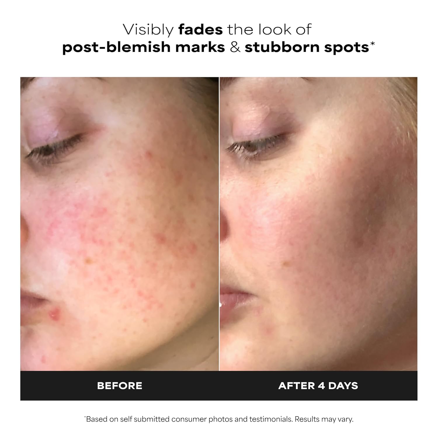 Thumbnail 1 de Paula's Choice BOOST 10% Azelaic Acid Booster Cream-Gel Serum with Salicylic Acid (Oil-Free, Fragrance-Free)