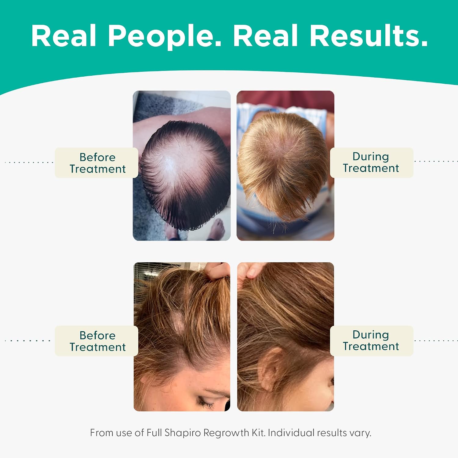 Thumbnail 4 de Shapiro MD Hair Loss Shampoo 1 Month