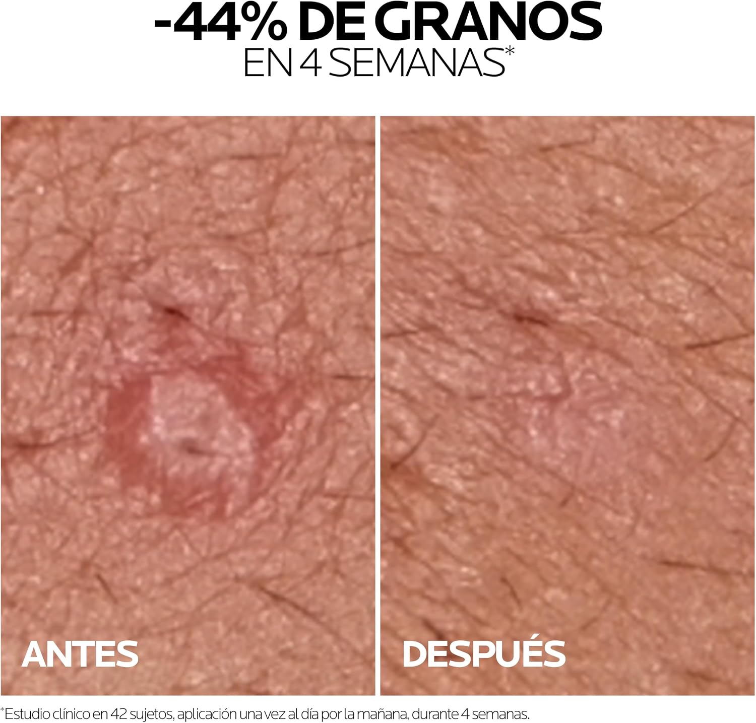 Thumbnail 4 de La Roche-Posay Effaclar Duo+M 40 ml