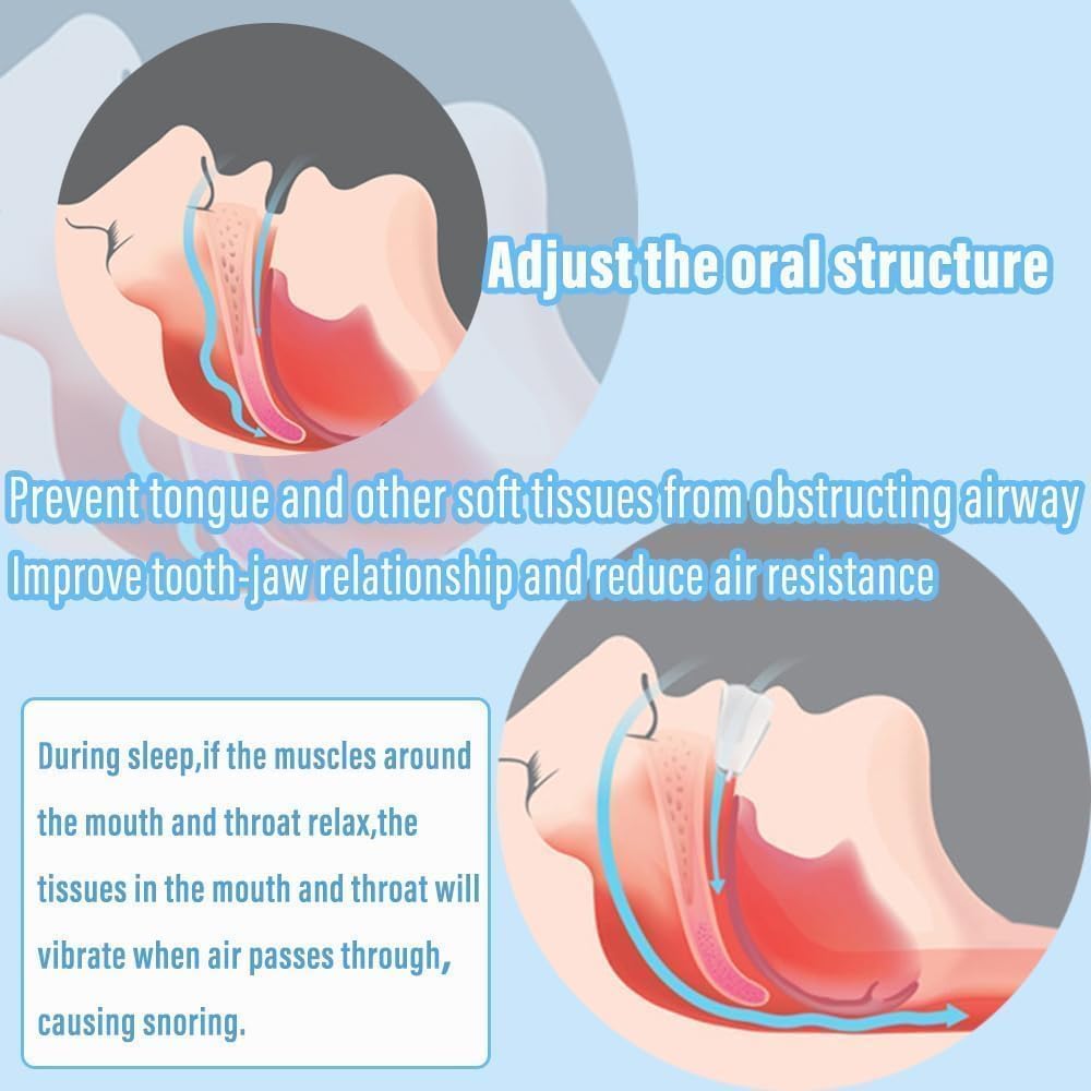 Detalle de AIOUTGOGO Anti Snoring Devices (2 Pack) soft anti-snoring mouthpieces for men & women