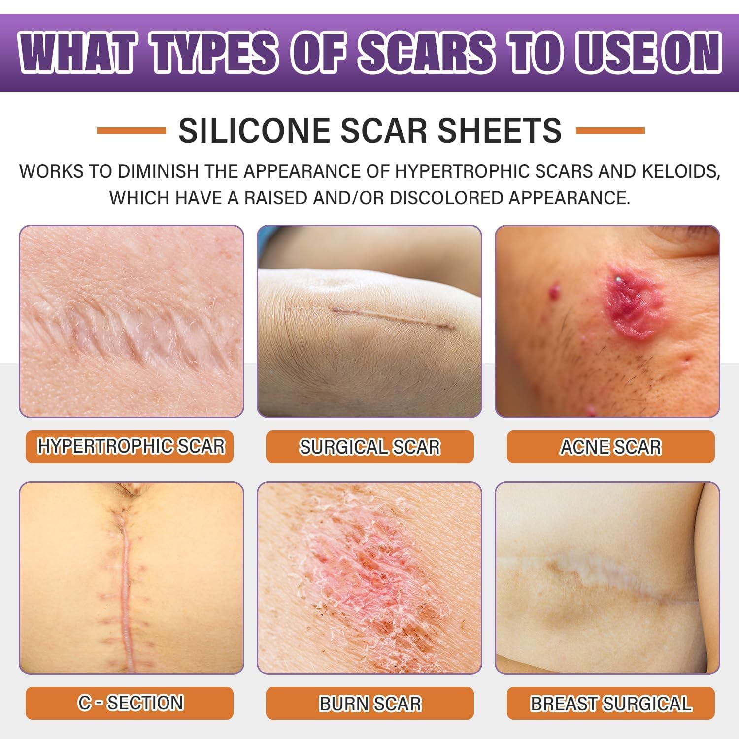 Detalle 2 de PSECICI Silicone Scar Tape Roll, Medical-Grade Silicone, 1.6" x 59
