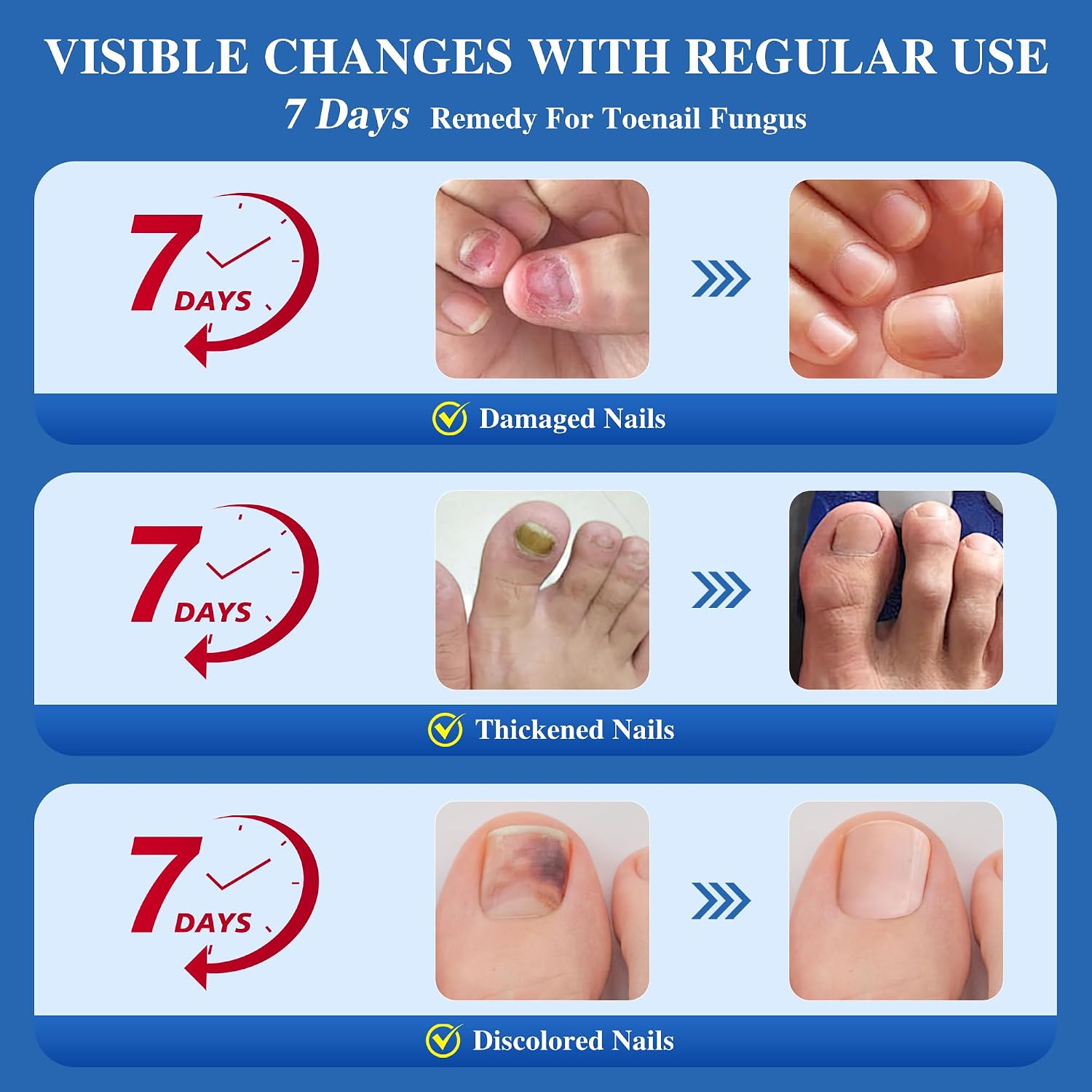 Detalle 2 de Toenail Fungus Treatment with 25% Undecylenic Acid