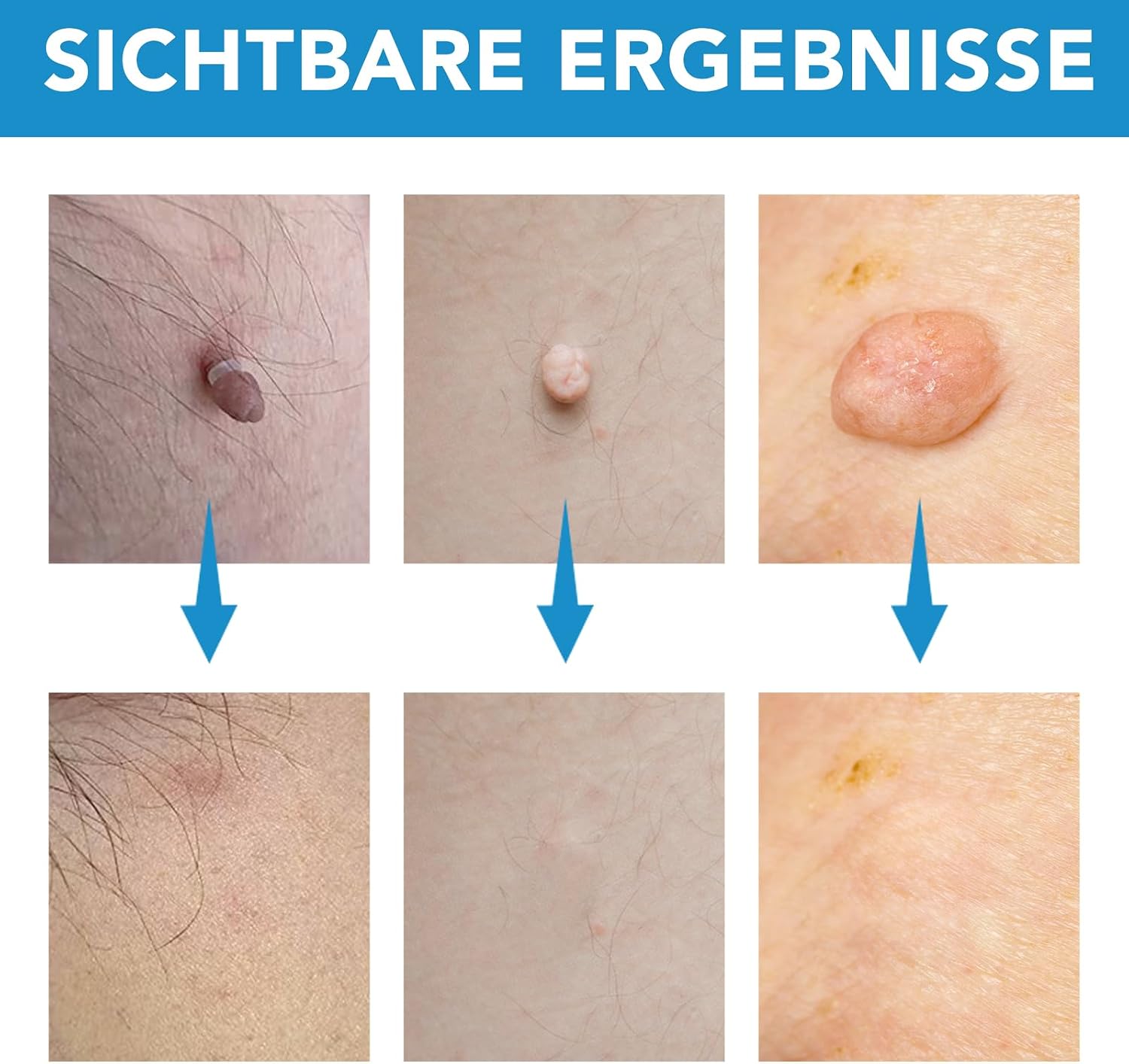 Thumbnail 5 de CFHQXSZ Skin Tag Removal Kit 40 Bands