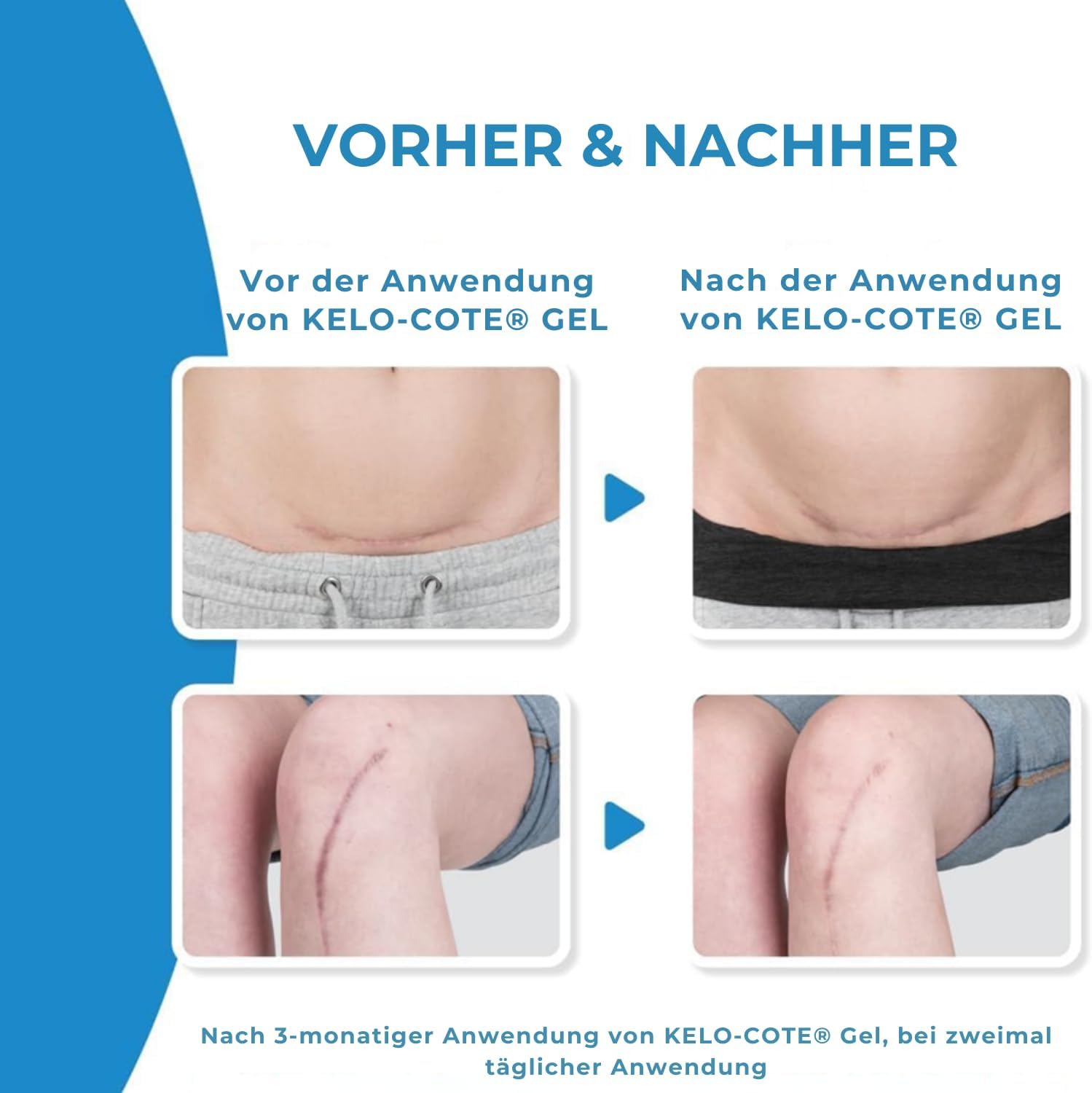 Thumbnail 6 de KELO-COTE Silikon-Narben-Gel 6 g – Für narbige, hypertrophe und Keloidnarben