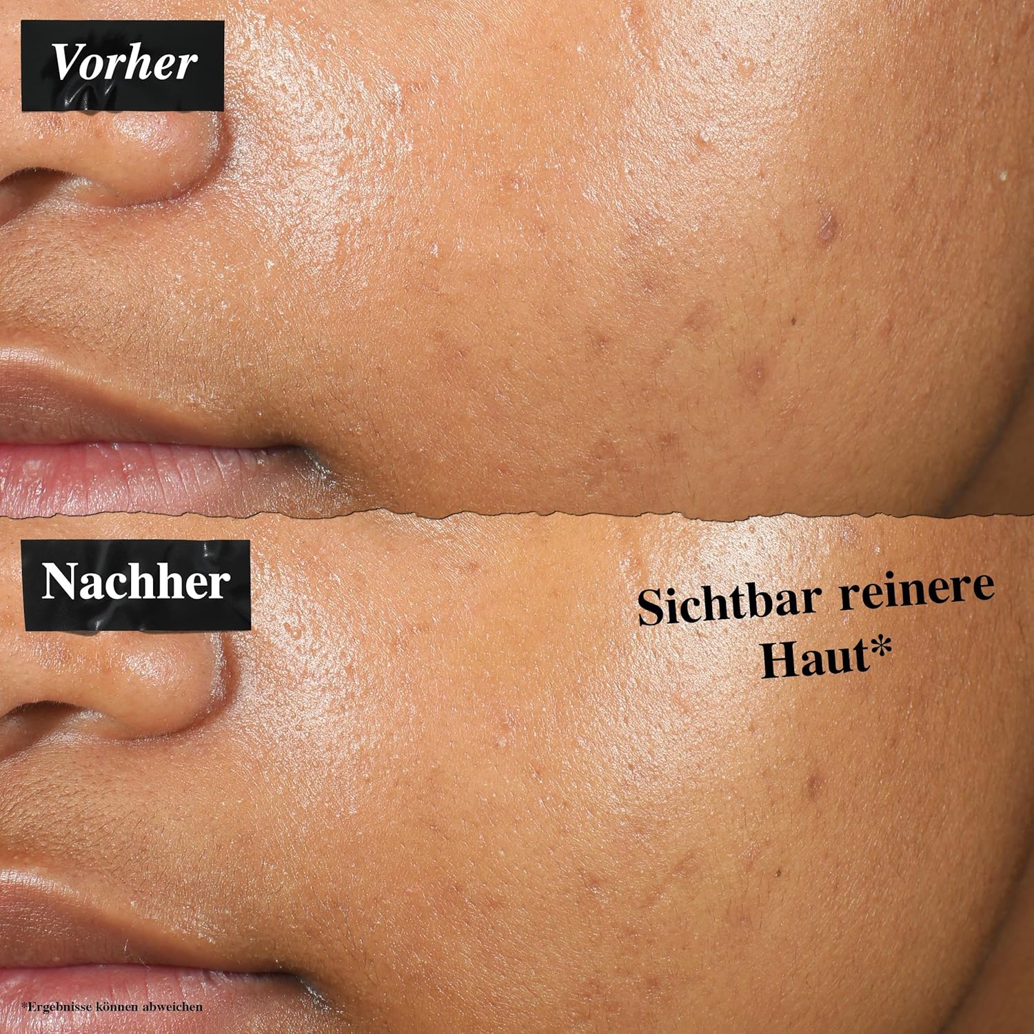 Thumbnail 4 de Kiehl’s Truly Targeted Blemish Clearing Solution (15 ml) – unsichtbares flüssiges Pickel-Patch mit Salicylsäure