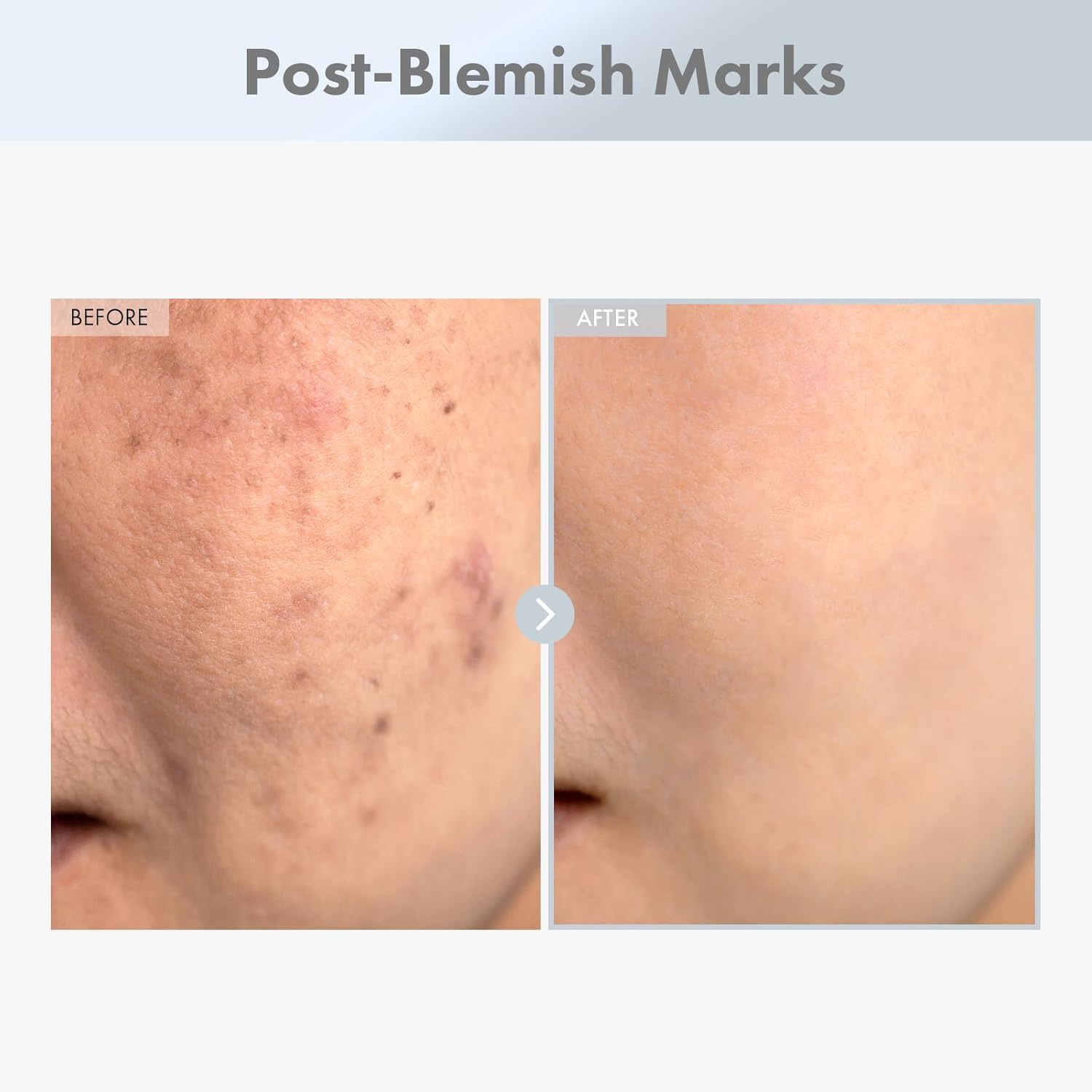 Thumbnail 2 de Siero alla Niacinamide 15% TOSOWOONG con Acido Tranexamico e Zinco PCA, 30 ml