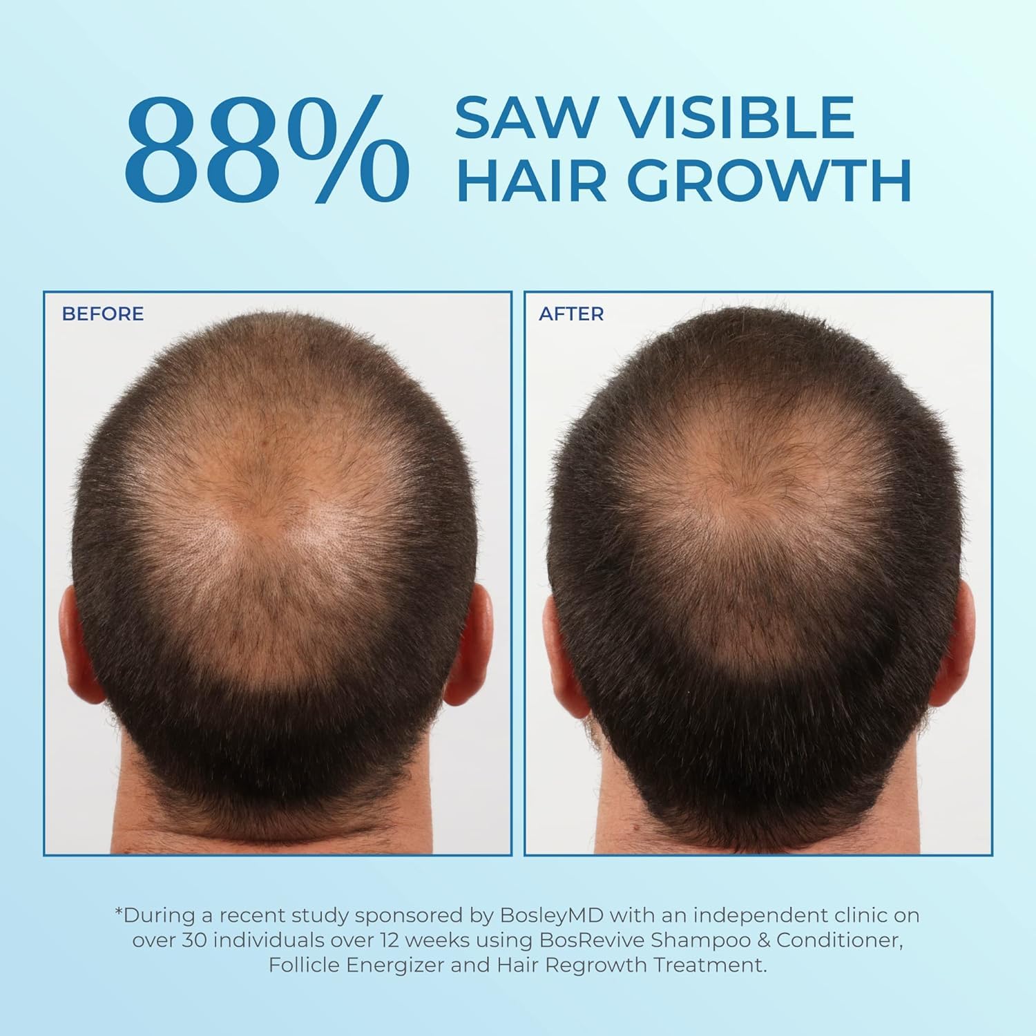 Detalle de BosleyMD Minoxidil Spray 5%