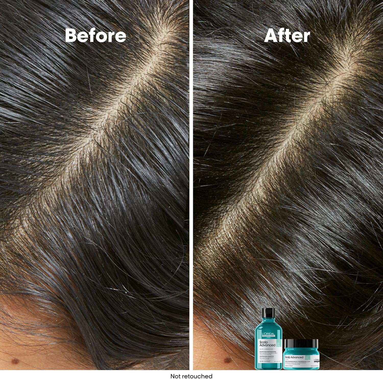 Thumbnail 4 de L'Oréal Professionnel Scalp Advanced Anti-Oiliness Dermo-Purifier Shampoo (300ml) – For Oily Hair, Serie Expert
