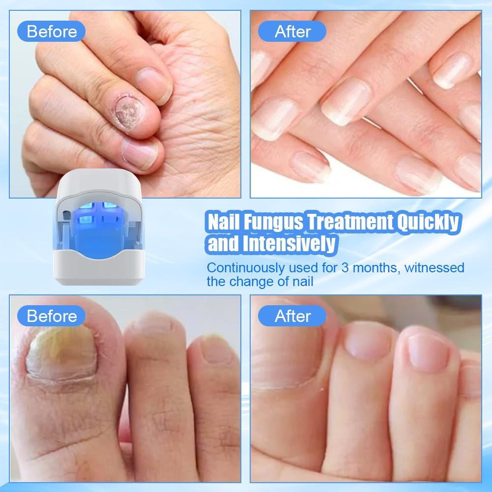 Detalle de ACWOO 4217544 nagelbehandlingsenhet med blått ljus, infrarött ljus och 7-minuterstimer