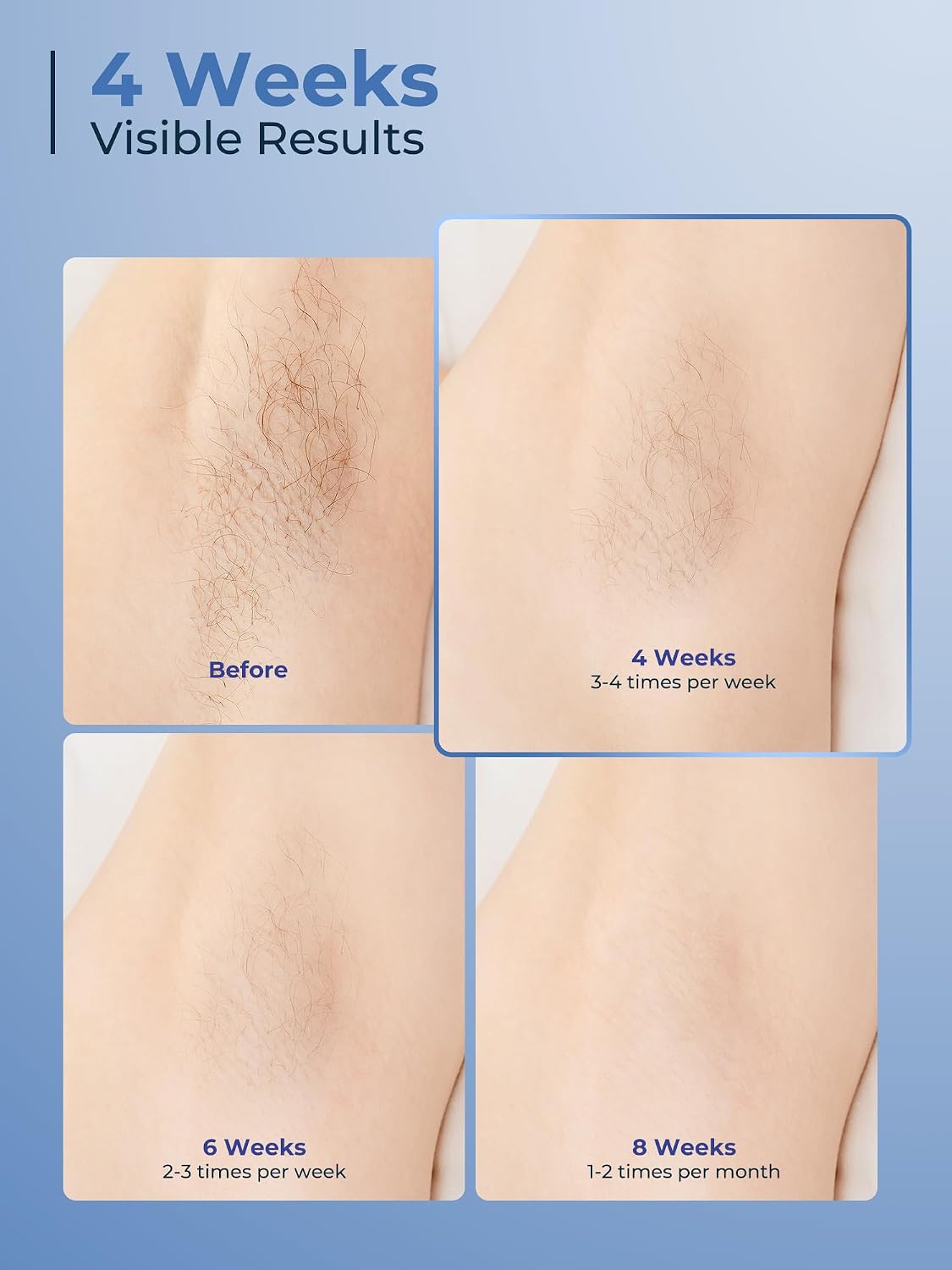 Detalle 2 de Finequin FZ-608G IPL Hair Removal Device with 41°F Cooling and 9 Intensity Levels