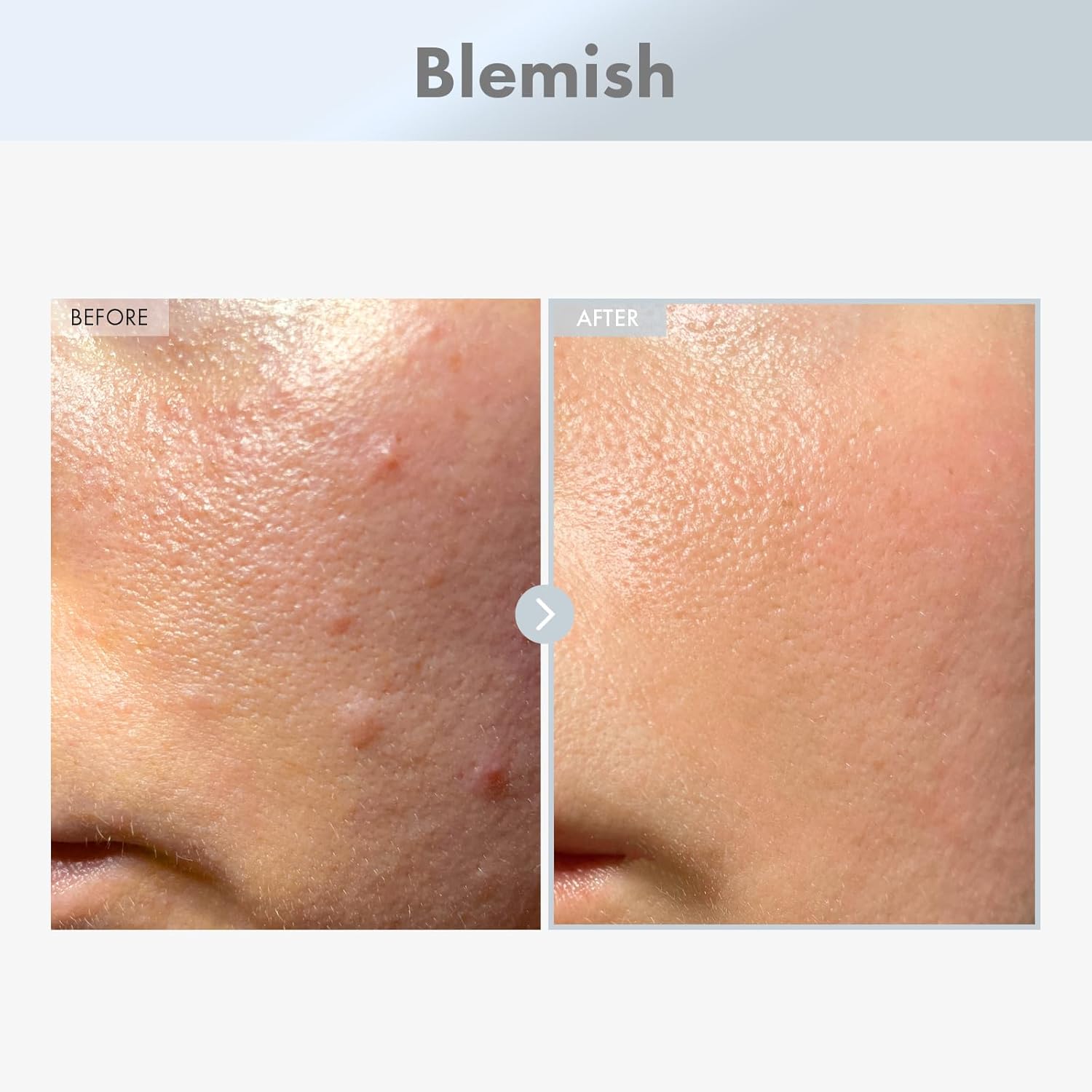 Thumbnail 1 de Siero alla Niacinamide 15% TOSOWOONG con Acido Tranexamico e Zinco PCA, 30 ml