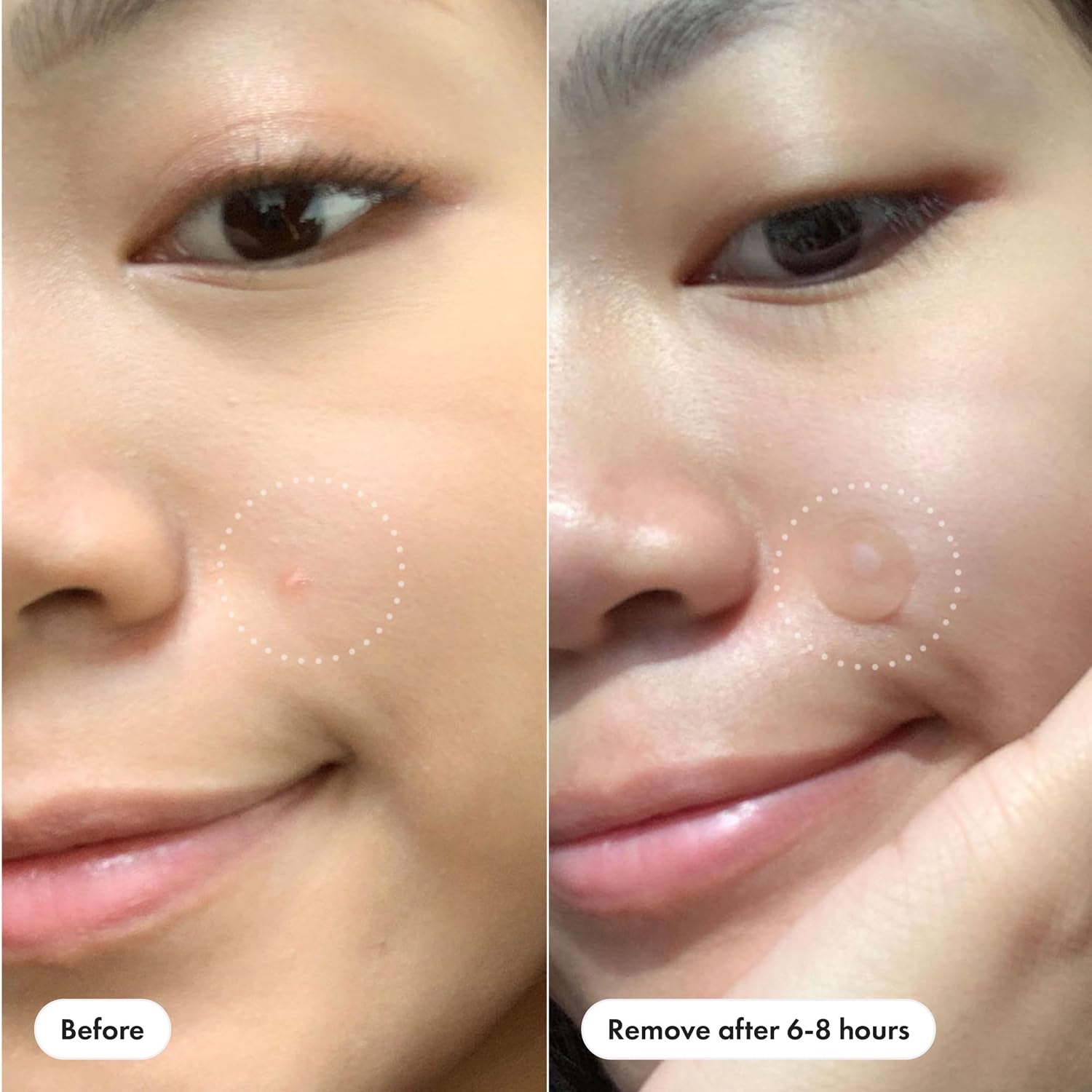 Thumbnail 4 de Mighty Patch Original Hydrocolloid Acne Patches by Hero Cosmetics (72 Pack)