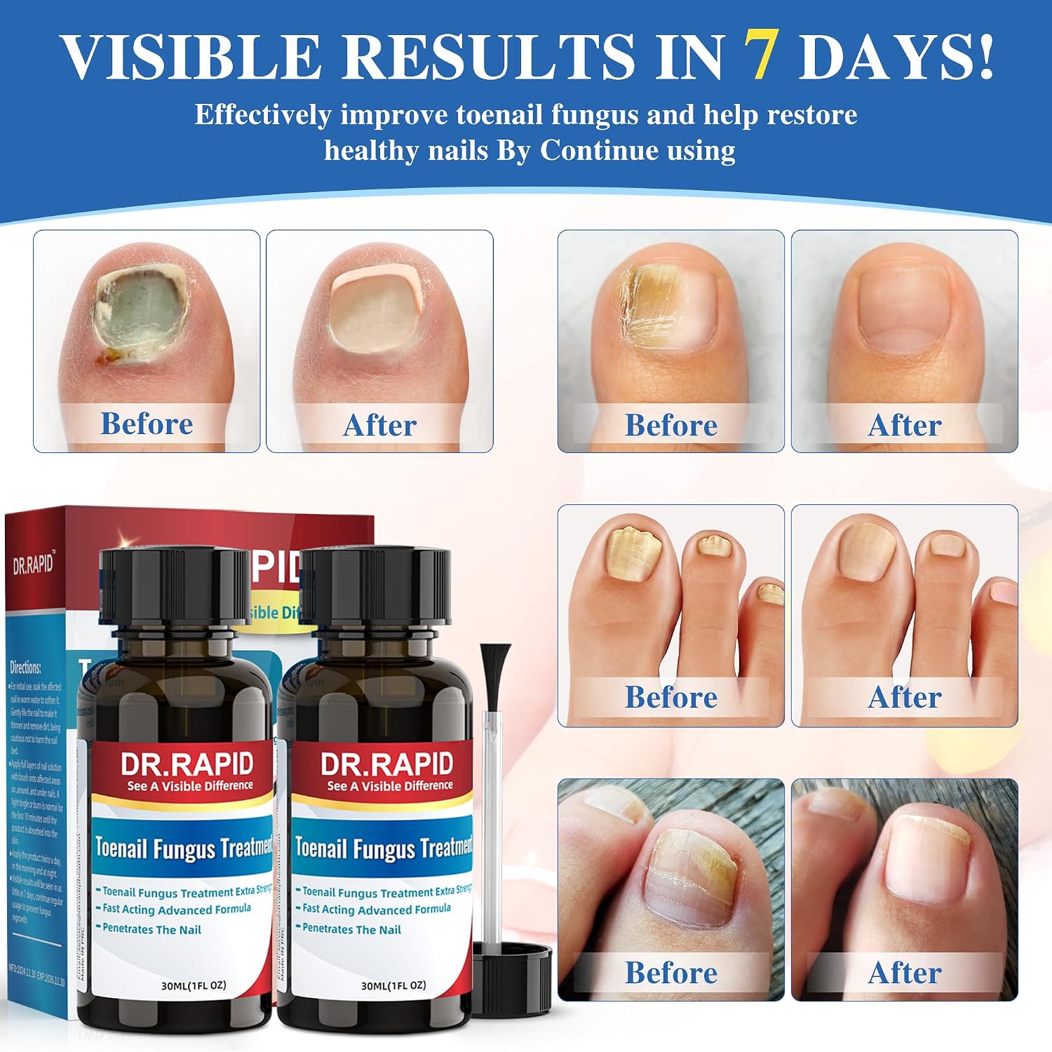 Detalle 2 de Toenail Fungus Treatment with 25% Undecylenic Acid