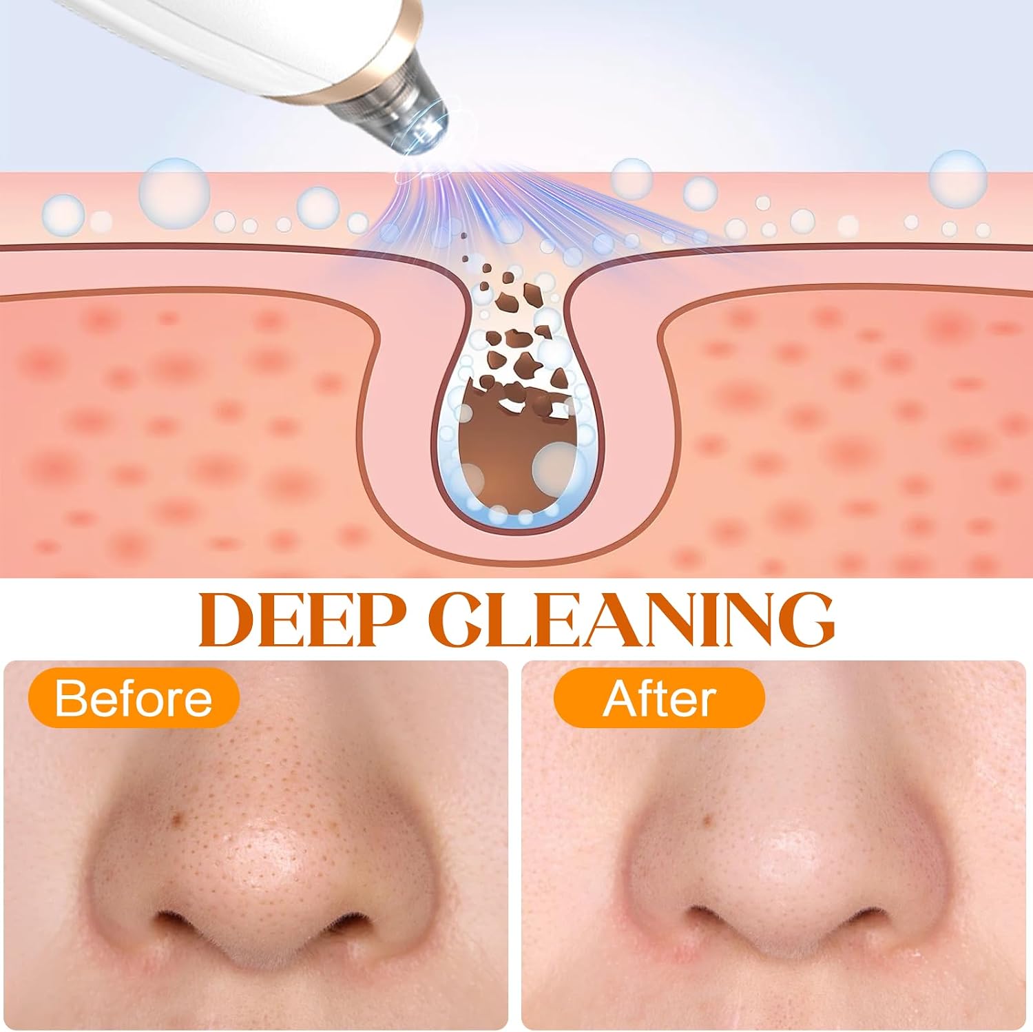 Thumbnail 2 de IGEAIIE Blackhead Remover Vacuum with 3 Suction