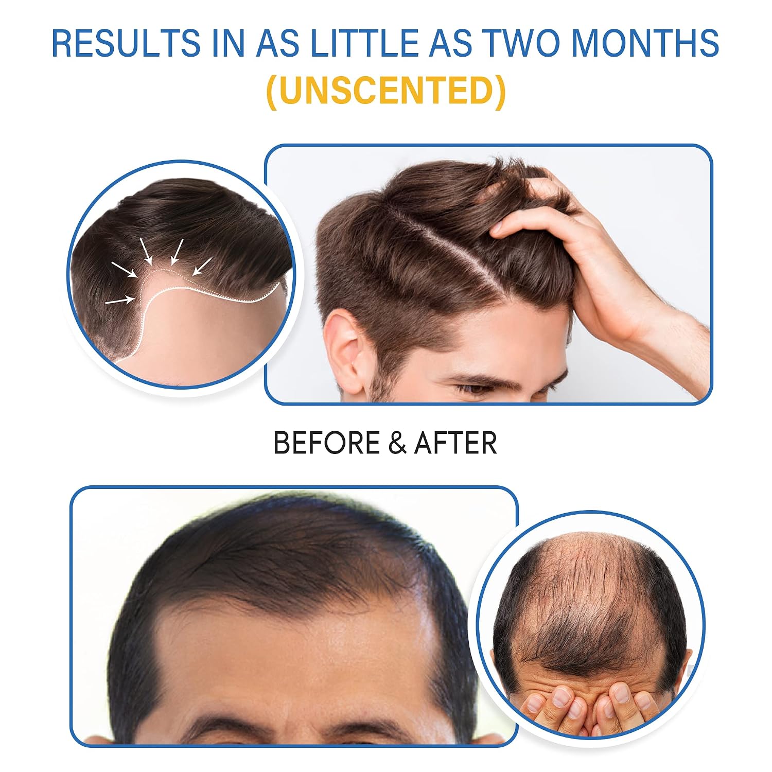 Detalle 2 de 5% Minoxidil Foam for Men and Women: Fast-Absorbing Hair Regrowth for Thinning Hair