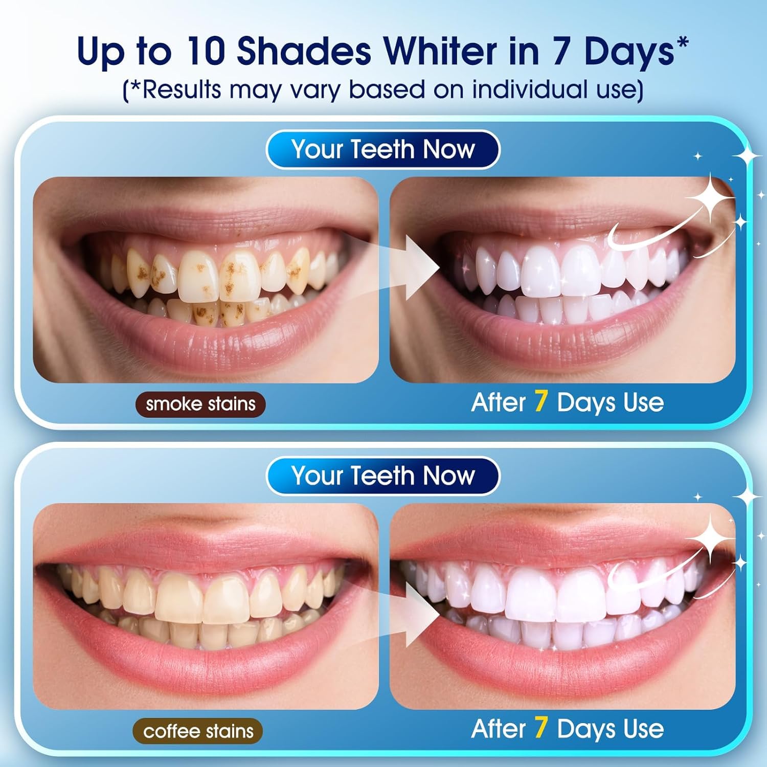 Thumbnail 1 de Teeth Whitening Kit with LED Light – 3 Pens + 2 Desensitising Pens (Mint) for a Brighter Smile