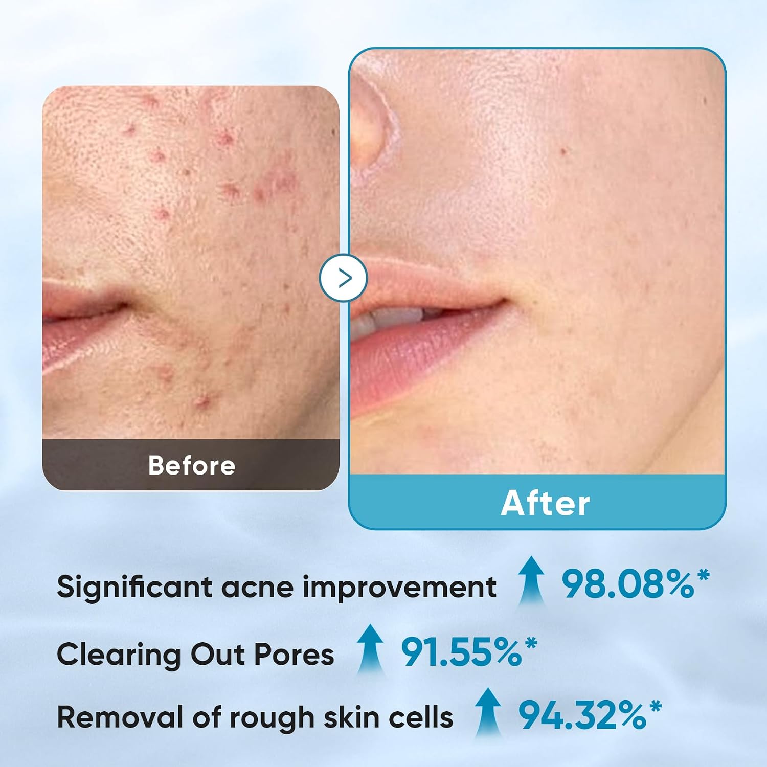 Detalle de Glycolic Acid and Salicylic Acid Facial Pads, 60 Pads