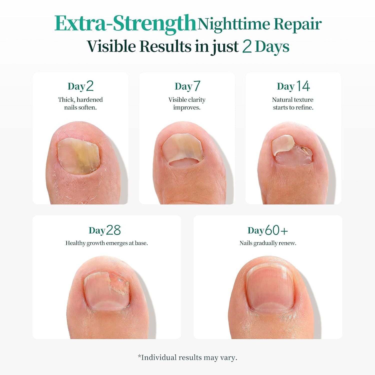 Detalle de APUREE Fungal Nail Patches Extra Strength with Tolnaftate 1% (32 Patch) for Overnight Toe Nail Treatment