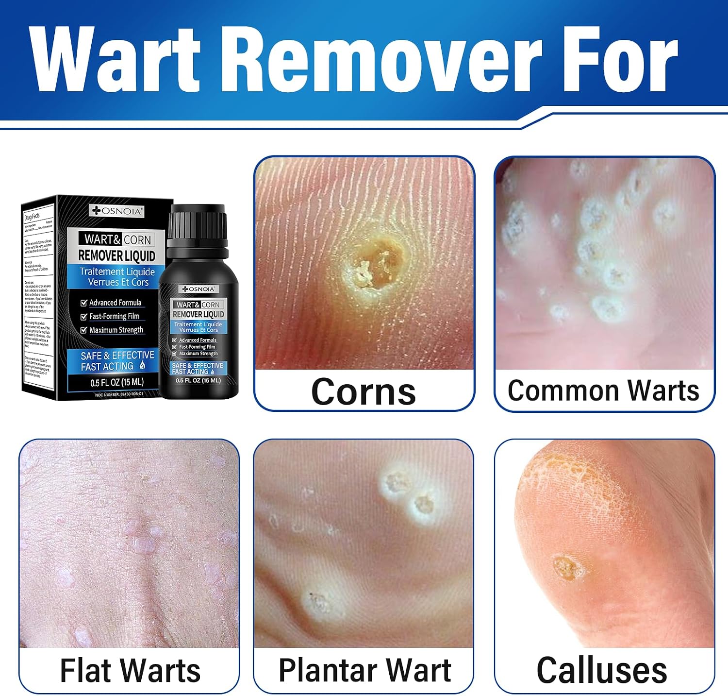 Detalle de OSNOIA Wart Remover Gel with Salicylic Acid, Fast-Drying 15 mL