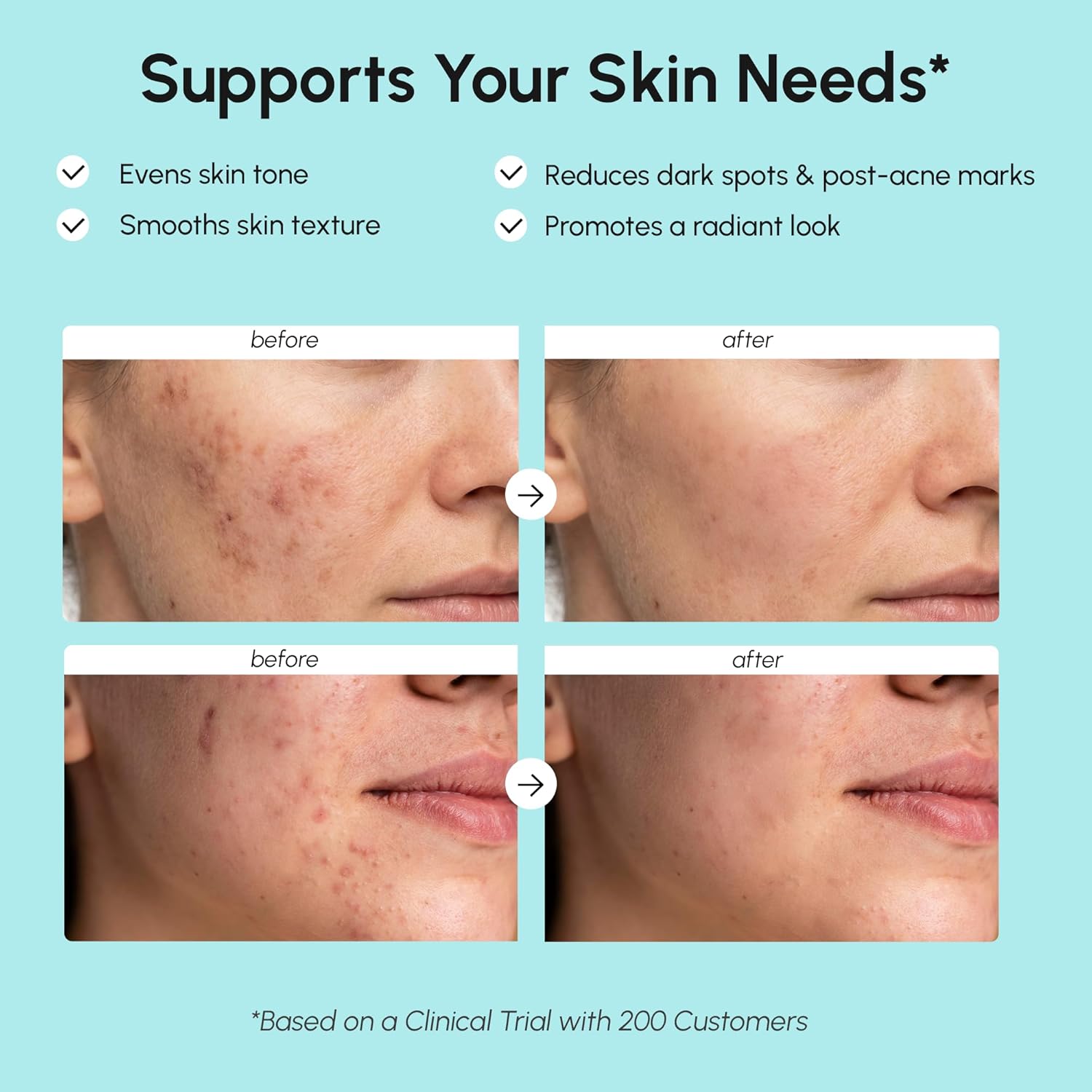Detalle de MAREE Azelaic Acid 15% Face Cream with Niacinamide & Salicylic Acid for Dark Spots, Redness, and Acne-Prone Skin
