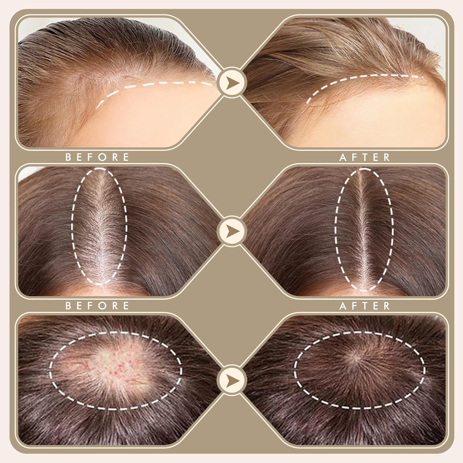 Thumbnail 6 de Derma Stamp 2-i-1 dermastamp med utbytbara huvuden och justerbart djup