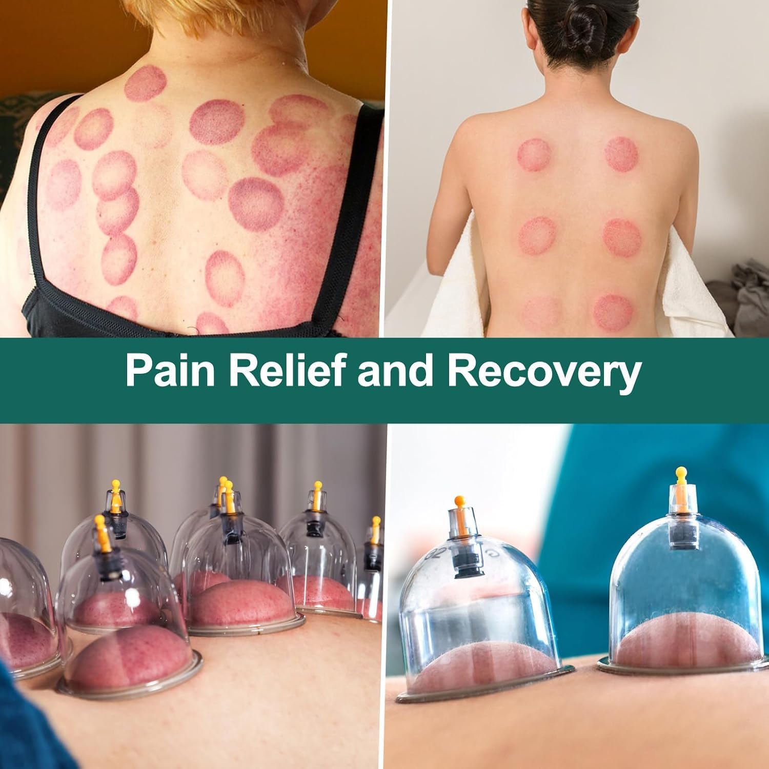 Detalle de OBLITOP Large Size V2.0 Cupping Therapy Set, 22 Cups and Hand Pump