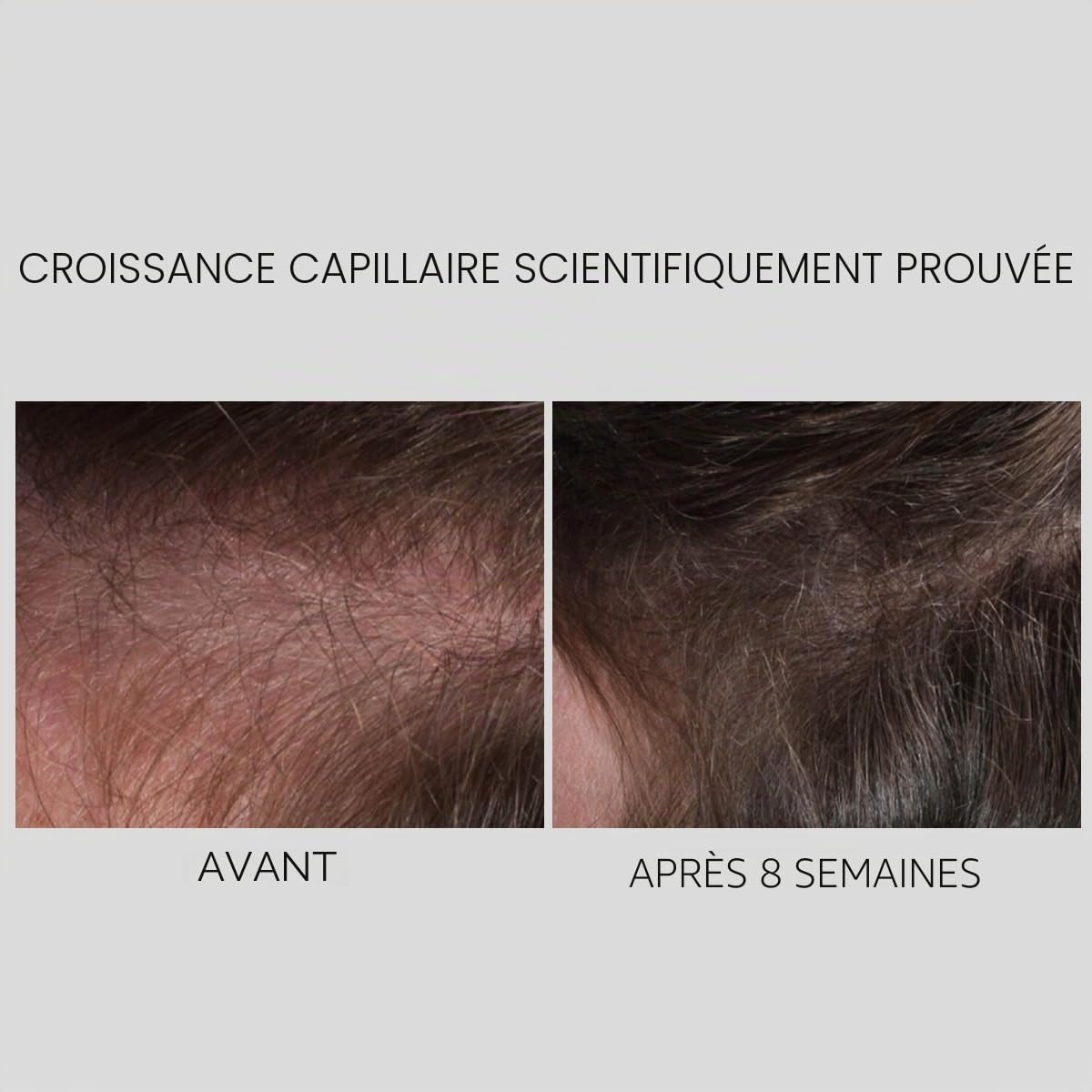 Thumbnail 2 de Nanogen Hair Growth Factor Treatment – sérum pour la pousse des cheveux à l’extrait de pea sprout, écorce et peptides (30 ml)