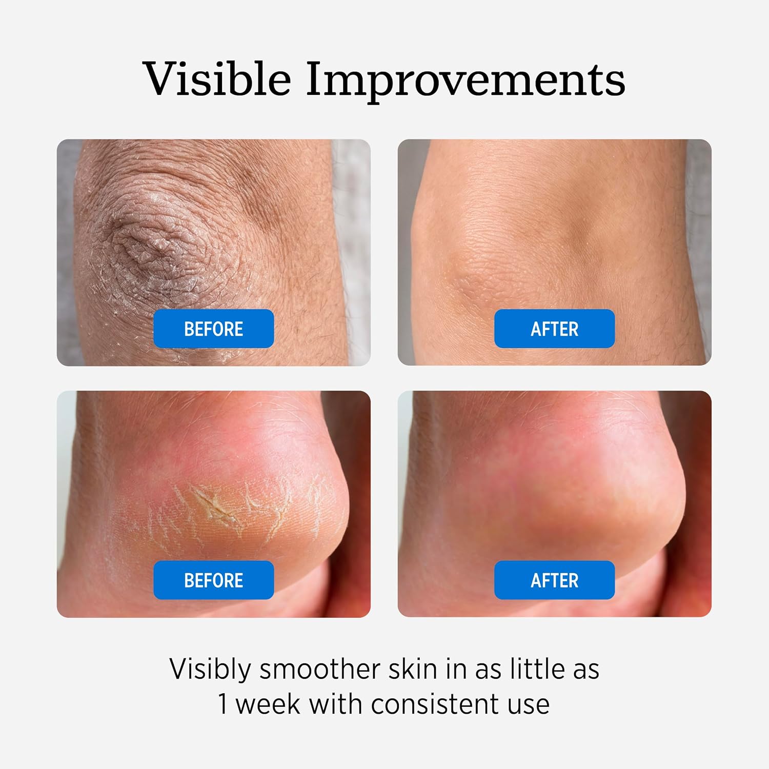 Thumbnail 6 de NUVADERMIS 40% Urea Cream — Intensive Full-Body Moisturizer for Extremely Dry Skin