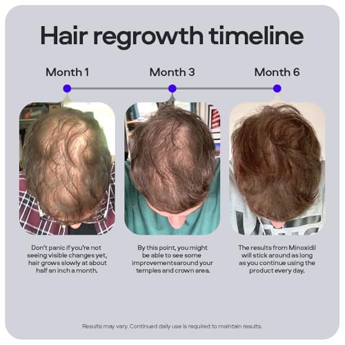 Detalle de Sons Minoxidil 5% Spray, 3 x 60ml Hair Regrowth Treatment for Men