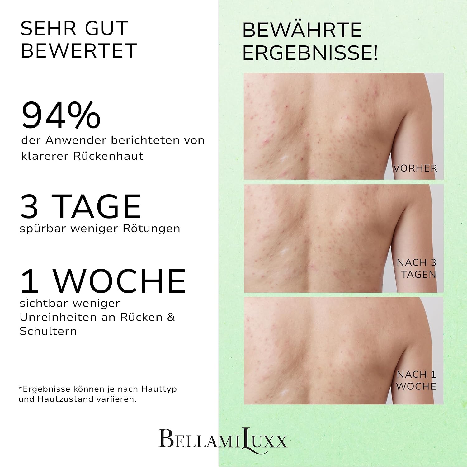 Detalle de BellamiLuxx Rücken- & Körper Akne Spray mit 2% Salicylsäure & Teebaumöl – Aknespray für Rücken, Brust & Schultern