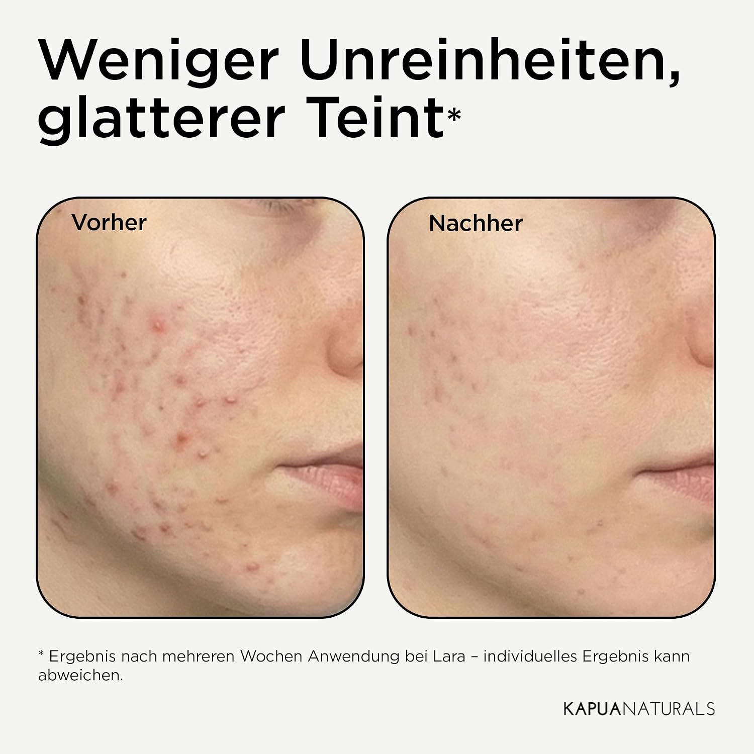 Detalle de Bio BHA Peeling 2% (100 ml) – Sanftes Hautpeeling mit BHA/AHA und Bio-Aloe für klare Poren