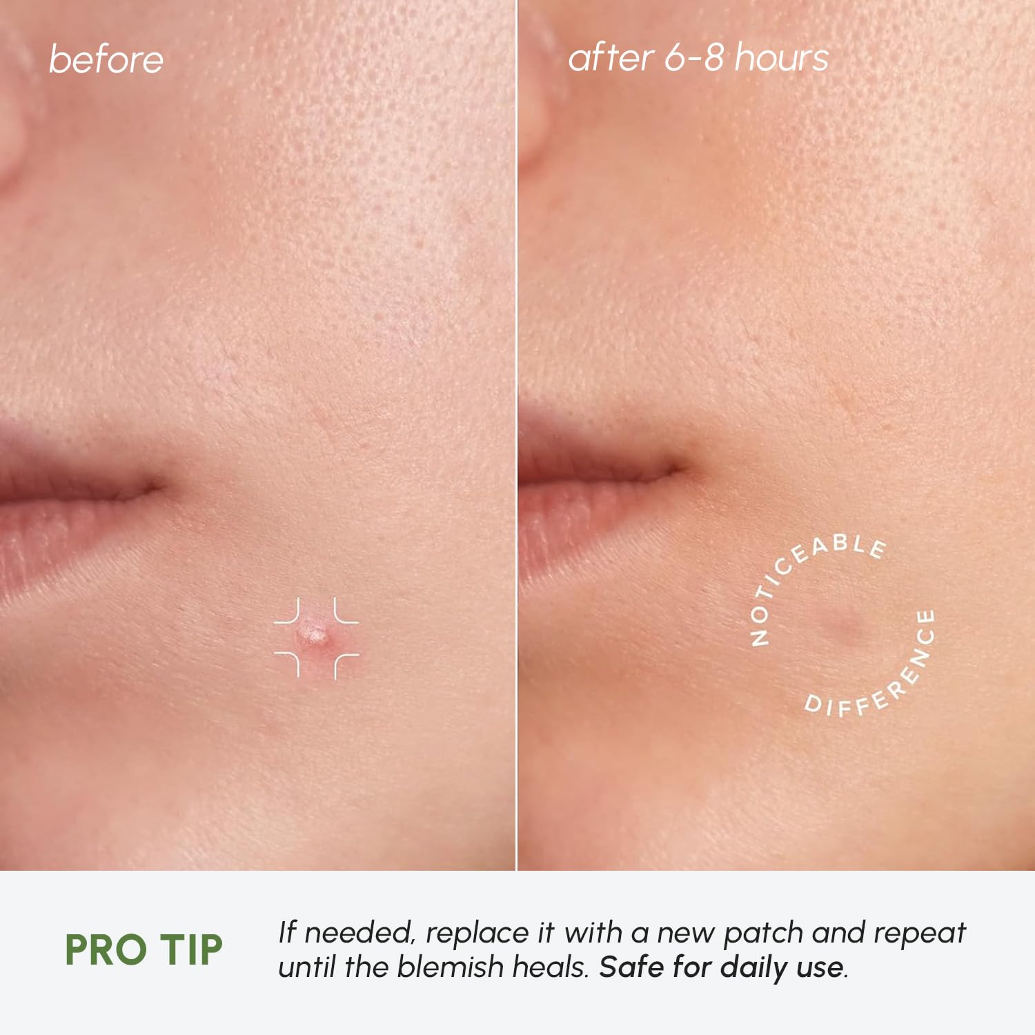 Thumbnail 4 de MAREE Invisible Pimple Patches 72 acne dots