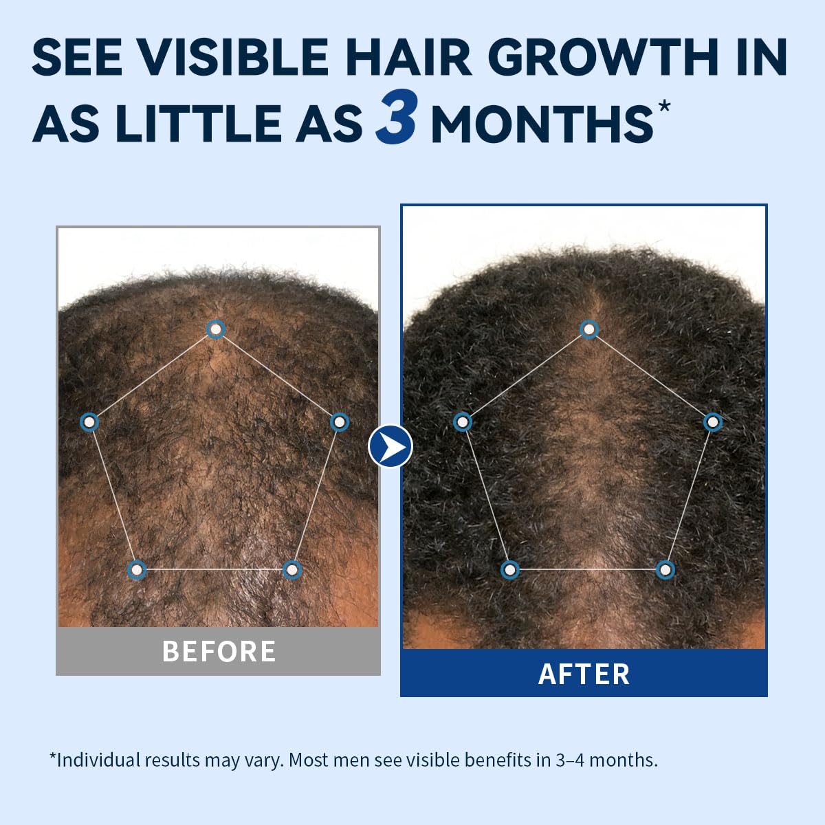 Detalle de AVITAPURE 5% Minoxidil Spray for Men, PG-Free and Fast-Drying