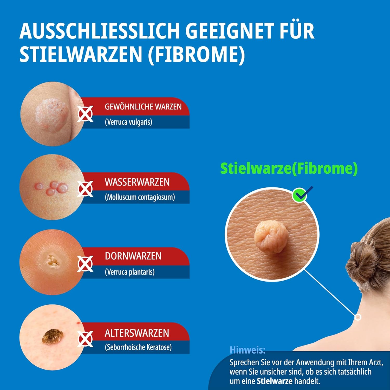 Detalle 2 de Evolsin Anti Stielwarzen Gel – natürliches Mittel gegen Stielwarzen