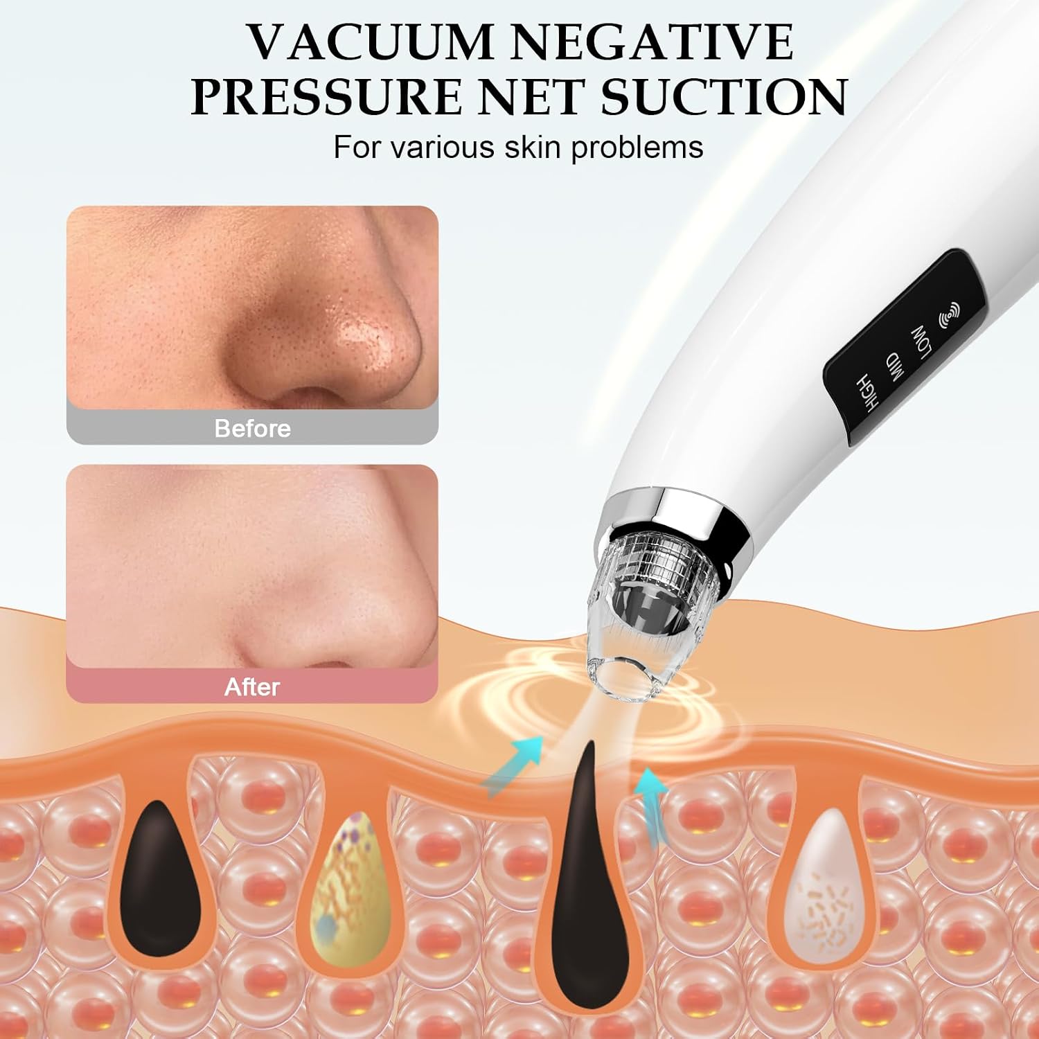 Thumbnail 2 de Blackhead Remover Pore Vacuum: 5 Probes, 3 Suction Levels, USB Rechargeable — White
